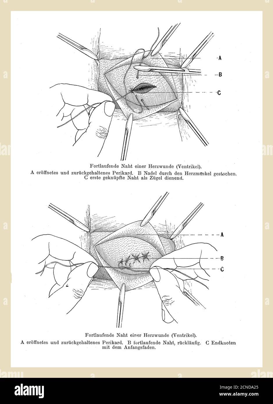 Santé, médecine et chirurgie: Suture d'une blessure cardiaque, illustration ancienne avec descriptions allemandes Banque D'Images