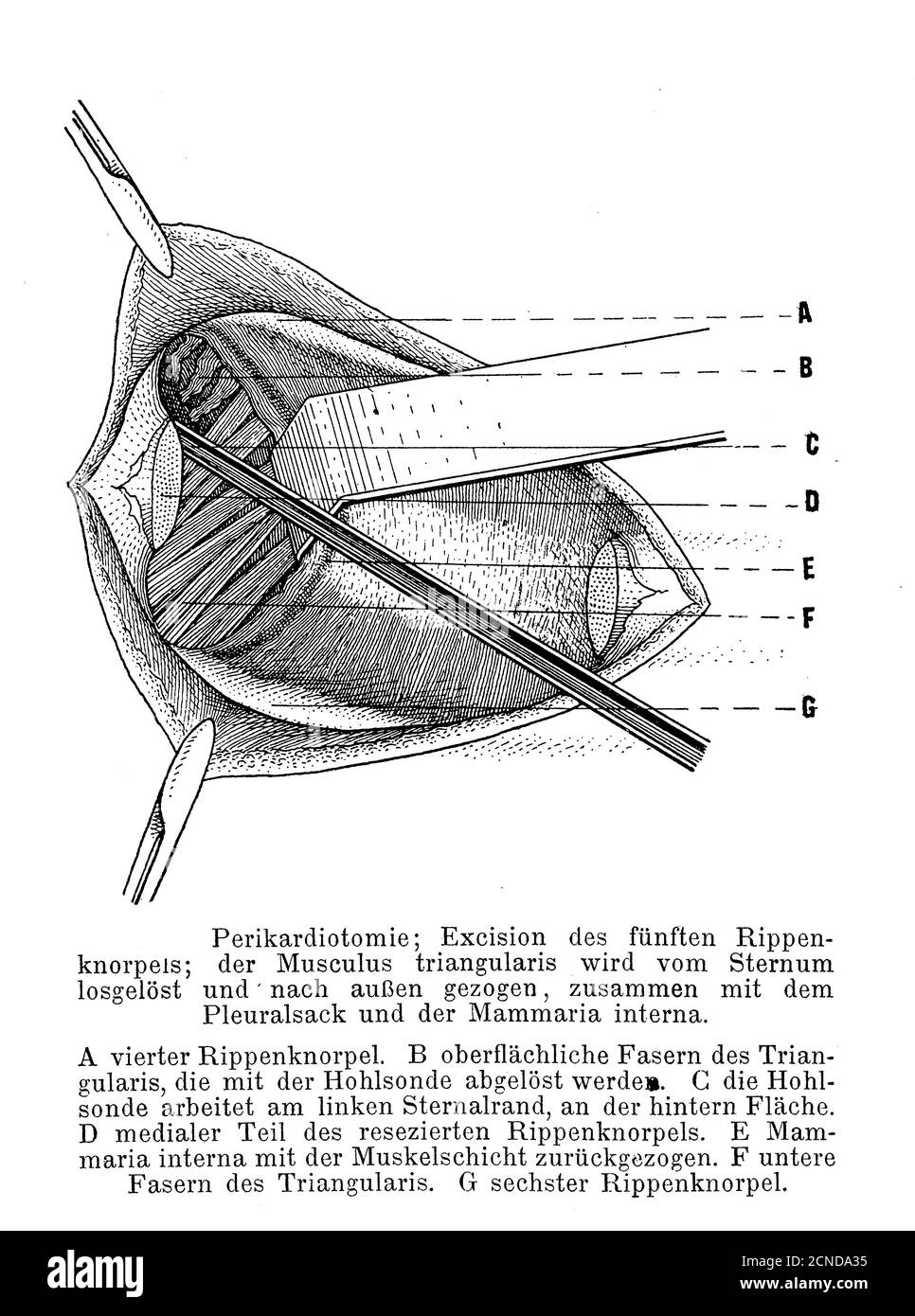 Soins de santé, médecine et chirurgie: Péricardiotomie, illustration ancienne avec description de l'opération en allemand Banque D'Images