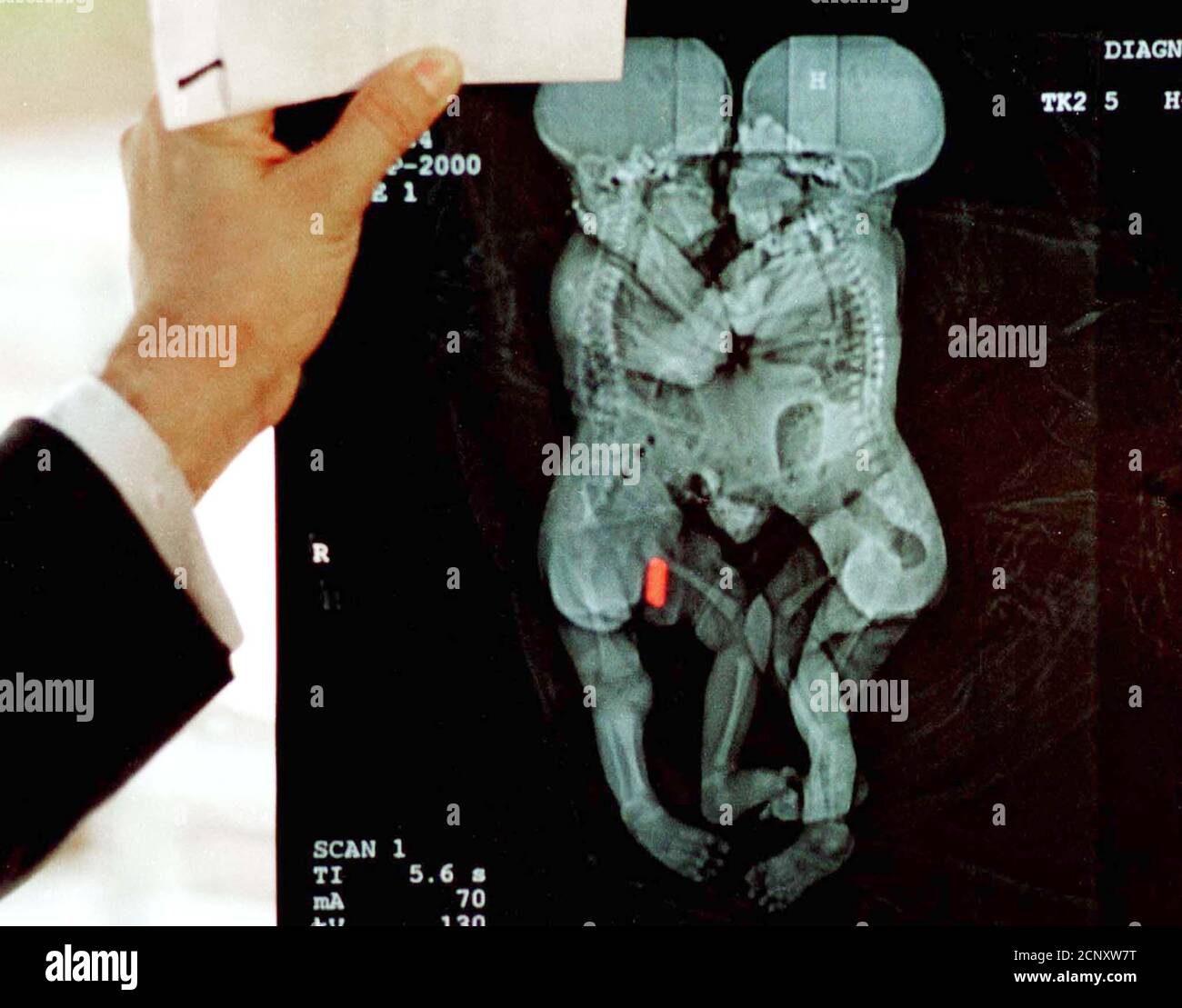 Un médecin présente une radiographie de jumeaux siamois colombiens dans la  ville de Medellin, le 14 septembre 2000. Un bébé Siamois colombien est  décédé tôt jeudi, moins de 24 heures après que