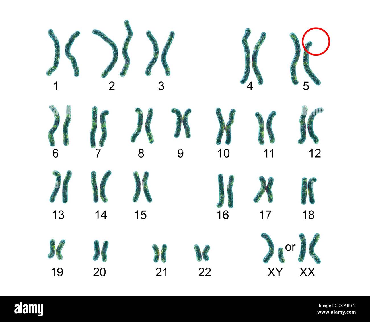 Caryotype D Un Patient Atteint Du Syndrome Du Chat De L Irc Egalement Connu Sous Le Nom De Syndrome Du Cri De Chat Illustration Informatique Le Syndrome De Cri Du Chat Est Un Groupe Caryotype D Un Patient Atteint Du Syndrome Du Chat De L Irc Egalement Connu Sous Le Nom De Syndrome Du Cri De Chat Illustration Informatique Le Syndrome De Cri Du Chat Est Un Groupe