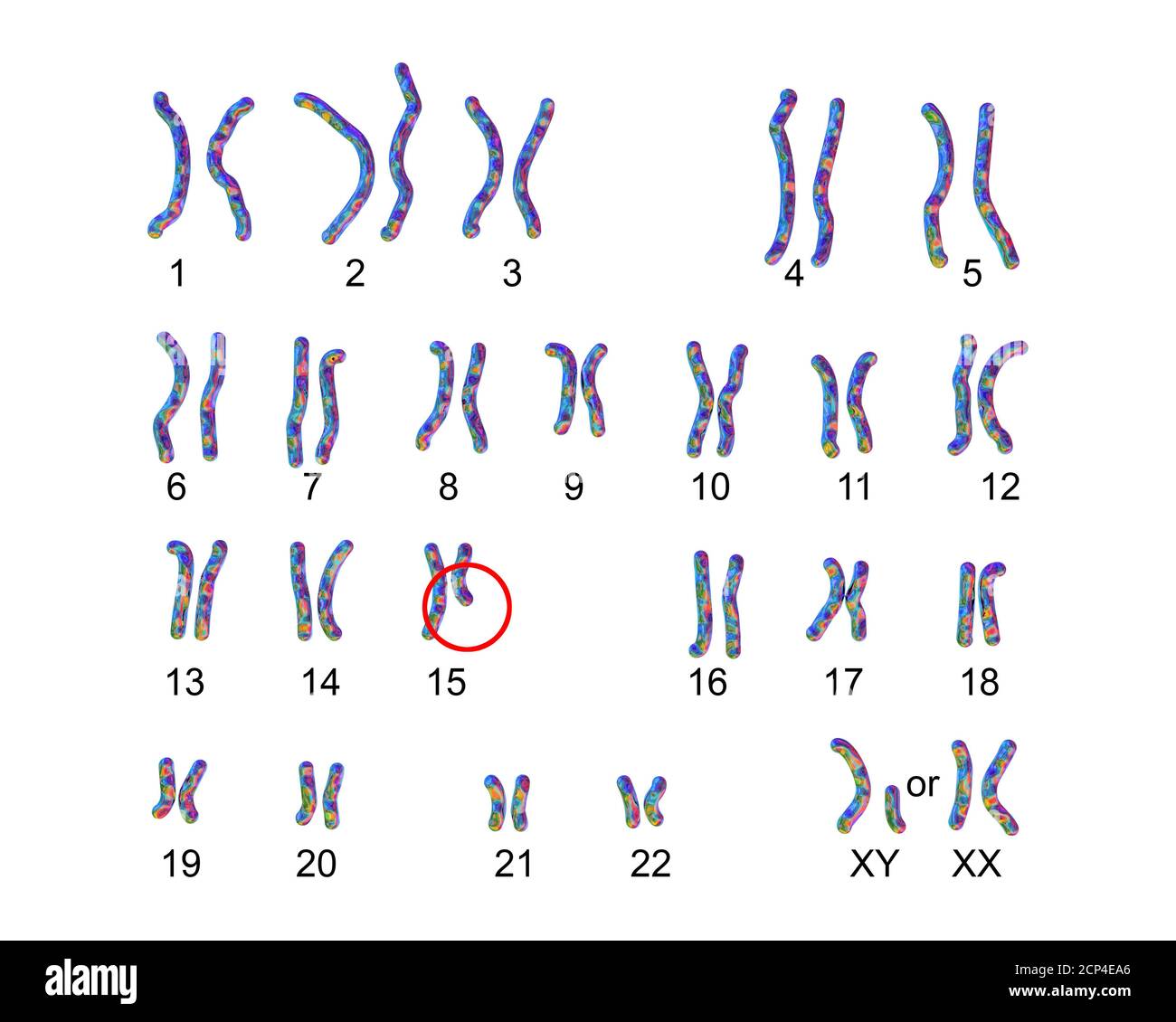 Caryotype du syndrome de Prader-Willi, illustration informatique. Il s'agit d'un trouble génétique causé par la suppression d'une région sur le chromosome 15 hérité fr Banque D'Images