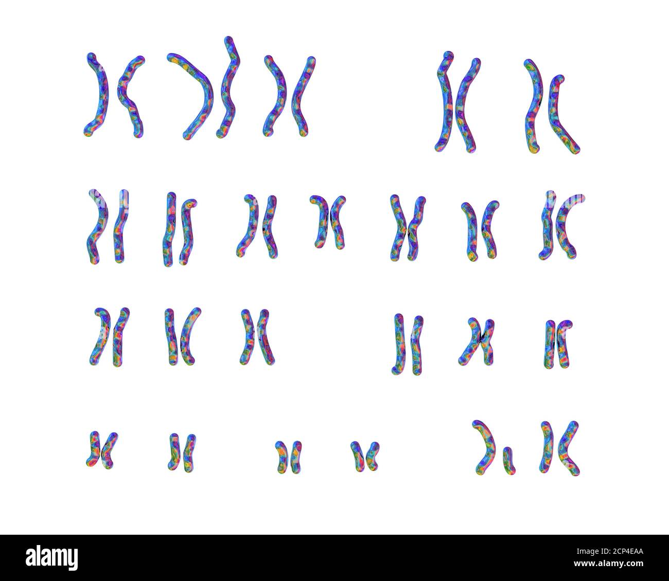 Caryotype D Un Patient Atteint Du Syndrome Du Chat De L Irc Egalement Connu Sous Le Nom De Syndrome Du Cri De Chat Illustration Informatique Le Syndrome De Cri Du Chat Est Un Groupe