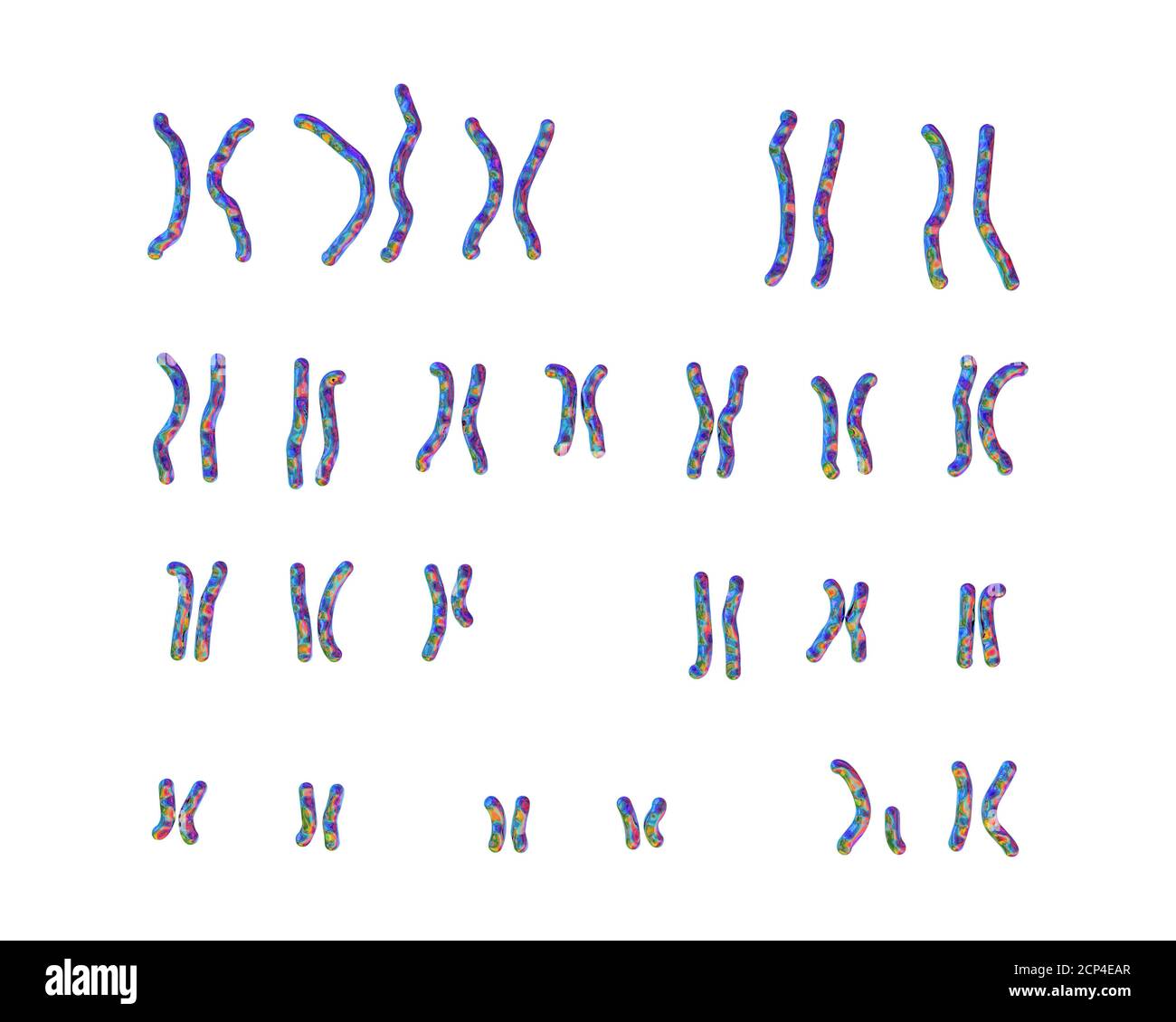 Caryotype du syndrome de Prader-Willi, illustration informatique. Il s'agit d'un trouble génétique causé par la suppression d'une région sur le chromosome 15 hérité fr Banque D'Images