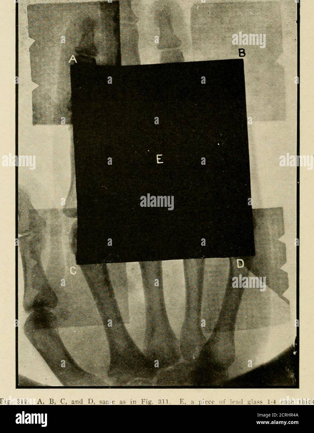. Radiographie élémentaire et dentaire / par Howard Riley Raper . Figure 311. A, B, C et D sont des morceaux de linoléum. E, un morceau de tôle de plomb 1-1 et lt; pouce, épaisseur Les appareils qui peuvent être utilisés pour les protec- flplianccs contre les rayons X sont : protection écrans de plomb protection. (Fig. 314 et 315), armoires de câbles de protection (Fig. 316 et 317), protections du tube (Fig. 60, 61. 63 et 64, chapitre III, et Fig. 318), tubes à rayons X de protection ou de sécurité (Fig. 319), gants résistants aux rayons X (Fig. 320), lunettes en verre de plomb (Fig. 321). et tabliers de protection. 280 RADIOGRAPHIE DENTAIRE .•— .. Banque D'Images