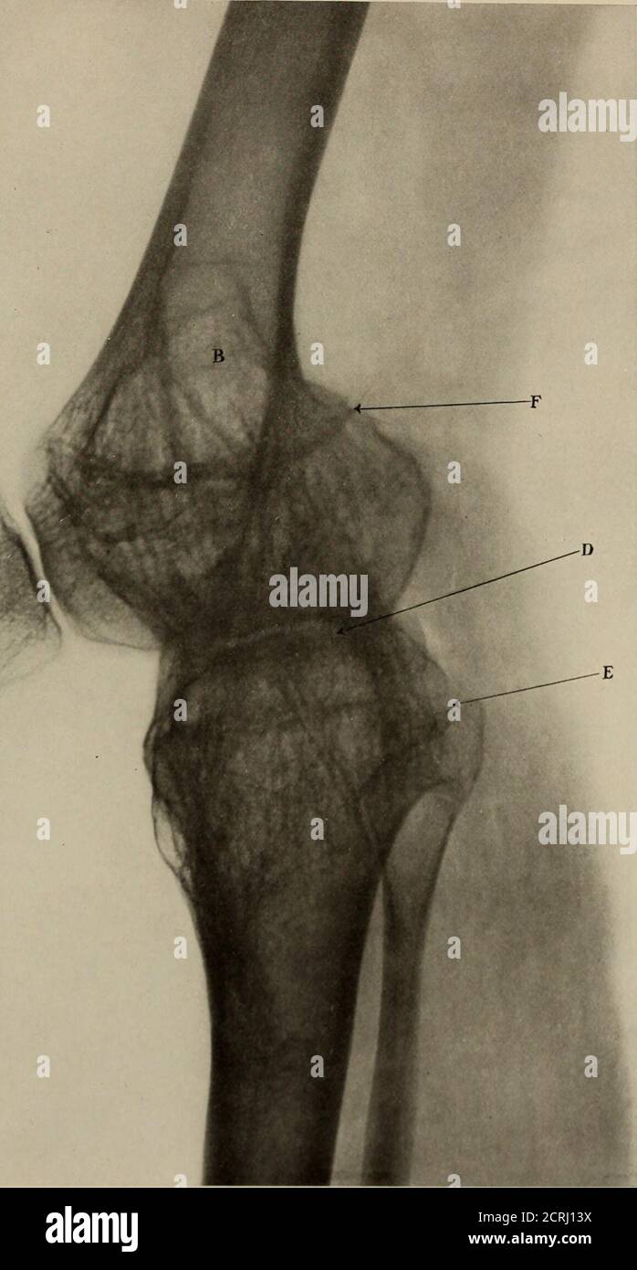 . Anatomie et pathologie vivantes; . PLAQUE 202.ANKYLOSIS DE L'ARTICULATION DU GENOU. Garçon, 13 ans. (Durée de vie.) A. rotule. B. disposition anormale de la trabécule de l'os. D. le pont osseux entre le condyle et l'épiphyse du tibia. E. les restes de la ligne épiphysaire dans la partie supérieure du tibia. F. les restes de la ligne épiphysaire à l'extrémité inférieure du fémur.Notez dans ce cas comment la structure de l'os est con tingante à travers les condyles. Tôle 202. PLAQUE 203.ARTHRITE INFECTIEUSE DANS L'ARTICULATION DE L'ÉPAULE. Fille, 8 ans. (Réduction de 13J%) (Même sujet que la planche 204 ) quelque peu Banque D'Images