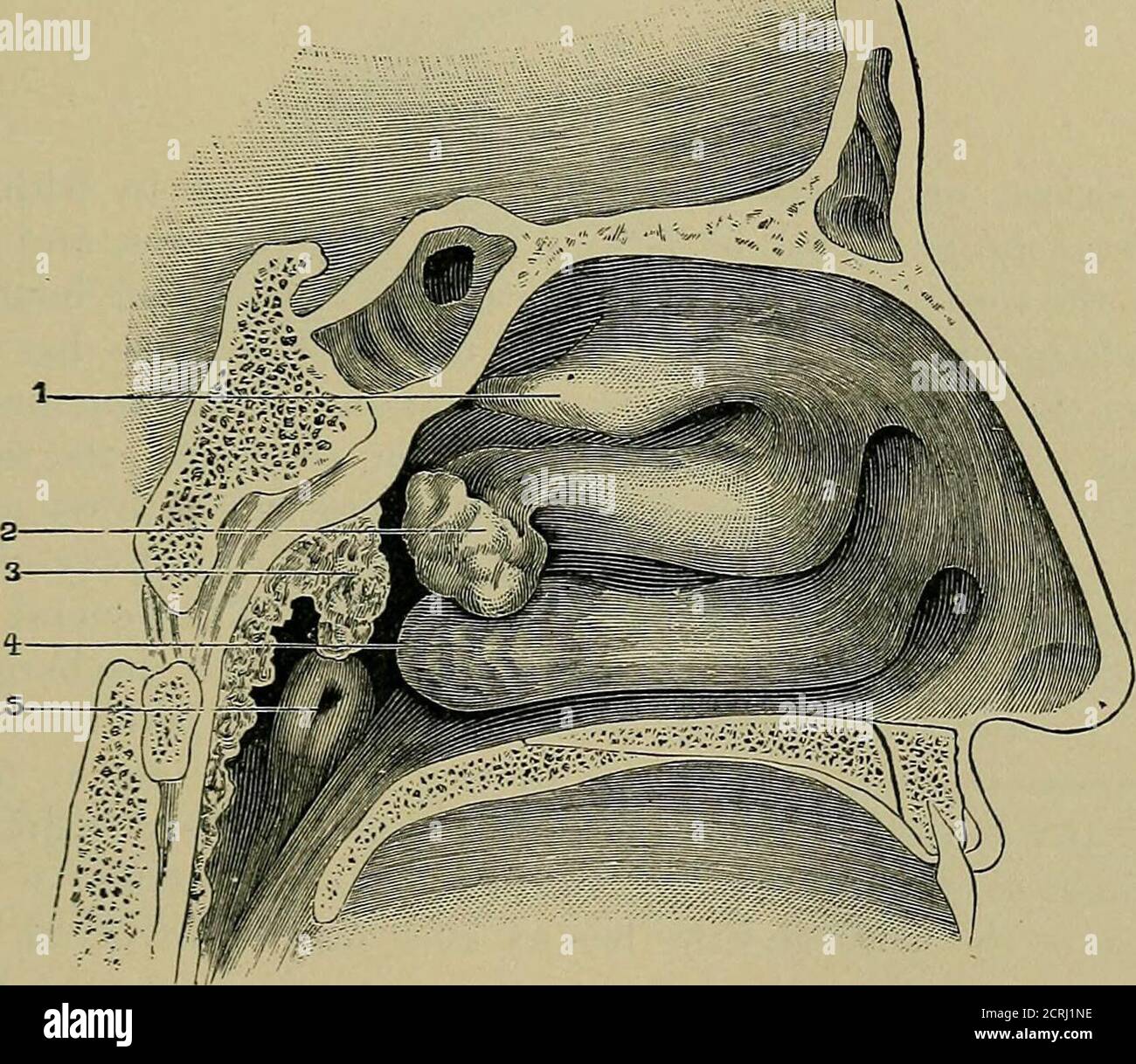 . Un traité pratique sur le diagnostic médical pour les étudiants et les médecins . la ficance est la suroccurrence de l'asthme, ou dyspncx?a soudaine, de réflexe excitati(m de la division pulmonaire du nerf pneumogastrique. Processus morbides. Les processus morbides sont les congestions ; les inflammations, qui peuvent être infectieuses, ou toxiques comme par les vapeurs ; les infections, étherprimary ou symptomatiques de certaines maladies générales; et les croissances morbides.les inflammations aiguës sont significatives des maladies exauthemateuses, par-ticulily rougeole. Comme Meigs l'a fait remarquer, une inflammation aiguë avec une grande obstruction des narines et une abonne Banque D'Images