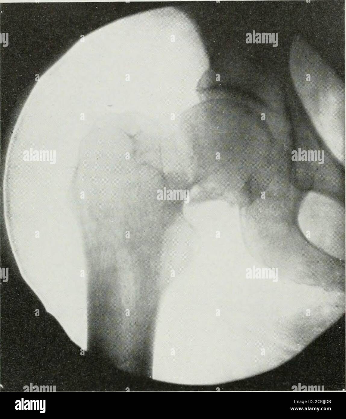 . La revue américaine de roentgoenologie, de radium thérapie et de médecine nucléaire . Figure 9. Boîtier XO. 4859. Même cas que Fig. 8, SixMonths plus tard. L'image montre la réparation dans la colonne vertébrale et l'Union longue des processus transversaux montrant que les proc-esses transversales WuL unissant si pas trop largement séparé. Thispatient n'a pas de paralysie et pratiquement aucun handicap. 462 incapacité fonctionnelle à la suite de fractures avec surpassement de l'endscafracturée à l'aide d'une dislocation de la tête du rayon. Cette complication peut facilement être négligée. Un cas a été observé dans lequel la dislocation a recurré trois tim.es,. Figure 10. C Banque D'Images