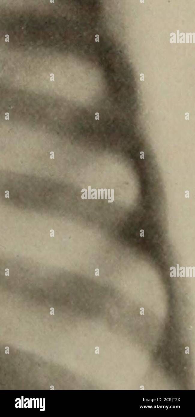 . Anatomie et pathologie vivantes; . /. PLAQUE 112.PNEUMONIE À PNEUMOCOQUE DOUBLE LOBAR. Garçon, 12 ans. (Réduit de 42 %.) A. consolidation du lobe inférieur sur le côté gauche. B. consolidation des lobes central et inférieur sur le côté droit. Tôle 112 Banque D'Images