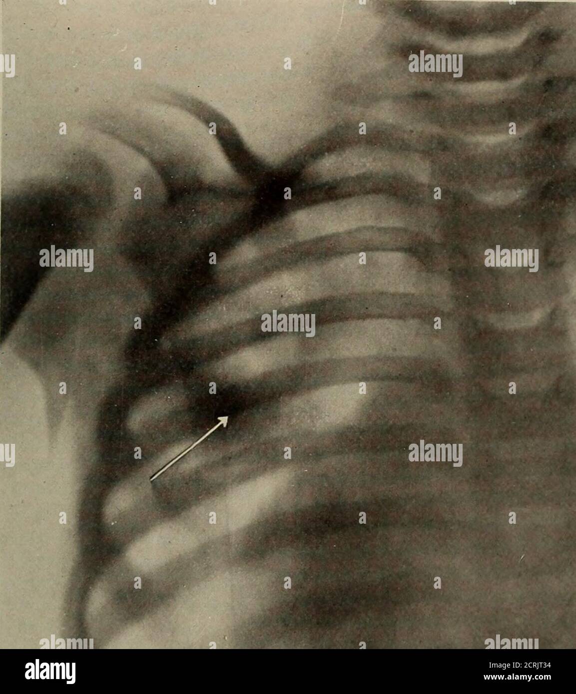 . Anatomie et pathologie vivantes; . PLAQUE 111.PNEUMOCOQUE LOBAR PNEUMONIE. Fille, 3 ans. (Réduit de 33 %.) La flèche pointe vers une consolidation du lobe supérieur du poumon gauche, à environ le niveau de l'angle de la scapula. Tôle 111. / Banque D'Images