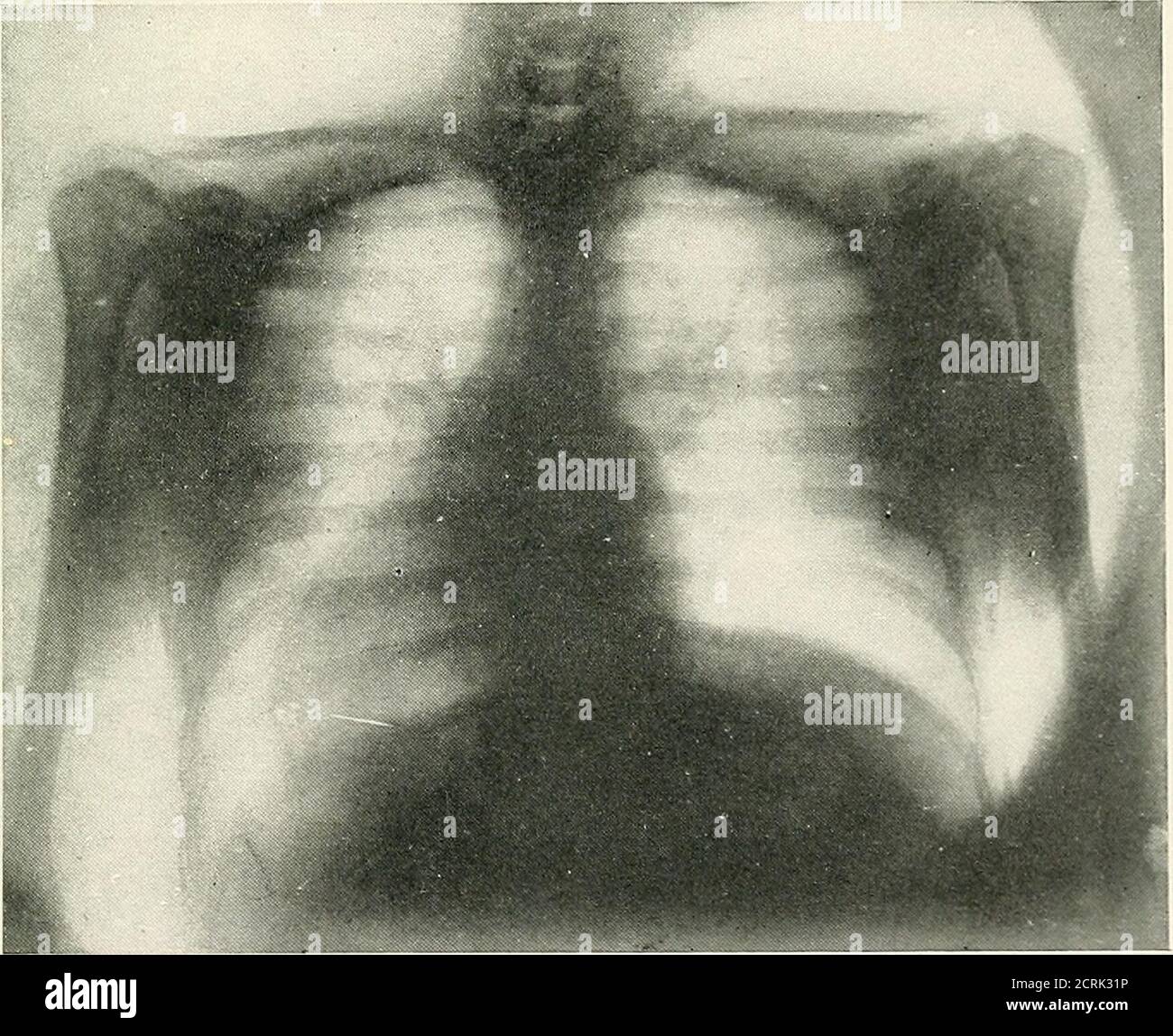 Pulmonary tuberculosis radio Banque de photographies et d'images à haute  résolution - Alamy
