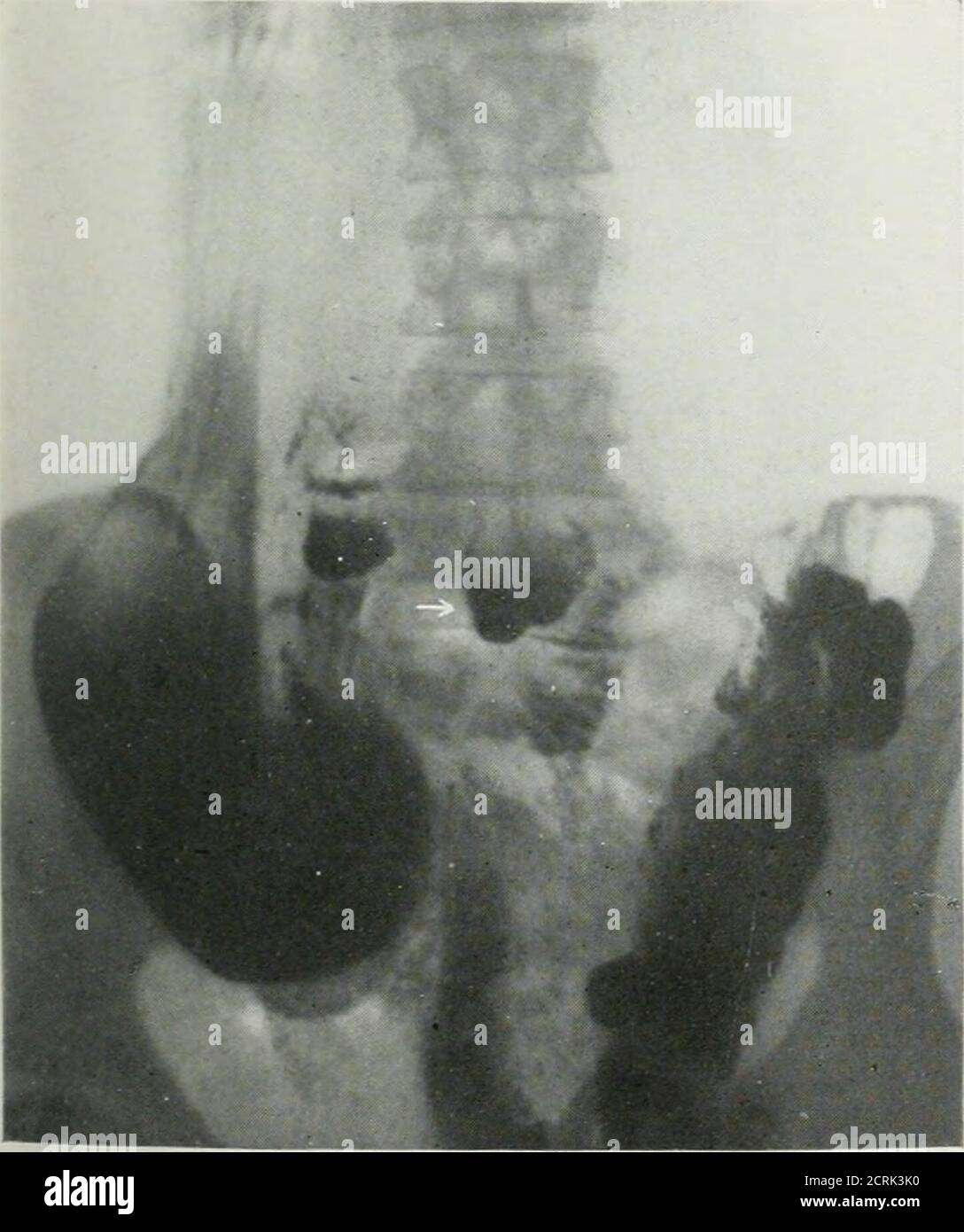 . La revue américaine de roentgoenologie, de radium thérapie et de médecine nucléaire . 2 lbs.; hauteur 5 pi., 3^ in. Iperations: Hémorroïdes ont enlevé quinze oreilles il ya.présente plaintes.—elle a eu un jld récent. Suivie de pleurésie dans le côté droit. |il est maintenant faible et très épuisé. il se lasse et déverse du gaz de l'olon une à deux heures après avoir mangé, la nuit. Il y a une tendance tolonstipulation. Les Examhia-ions physiques et roentgen-ray.—ils montrent que le patient est de type asthénique aaarké. Les poumons montrent une diffuseibrose dans le lobe moyen droit. Estomacs bas et atonique; bulbe remplit le SH Banque D'Images