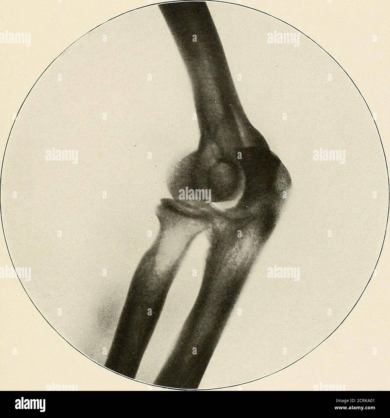 . Un atlas radiographique des changements pathologiques des os et des articulations . PLAQUE V. — 34- PLAQUE VI ARTICULATION NORMALE DU COUDE—VUE ULTÉRIEURE.L—IXTERXAL CO^•D^XE REPOSANT SUR LA PLAQUE À RAYONS X—LA PRONATION ET LA SUPINATION BETWEEX À MI-CHEMIN DE L'AVANT-BRAS, SA SURFACE ULNA REPOSANT SUR LA PLAQUE, LE POUCE REGARDANT VERS LE HAUT. La surface trochlear de l'humérus s'articule avec la plus grande cavité SIG-moid de l'ulna, et la tête radiale de l'humérus s'articule avec la tête du rayon. Les processus olecranon et coronoïdes, la plus grande cavitité sigmoïde de la cubitus, ainsi que la tête et le cou du rayon, sont nettement visibles. Le Banque D'Images