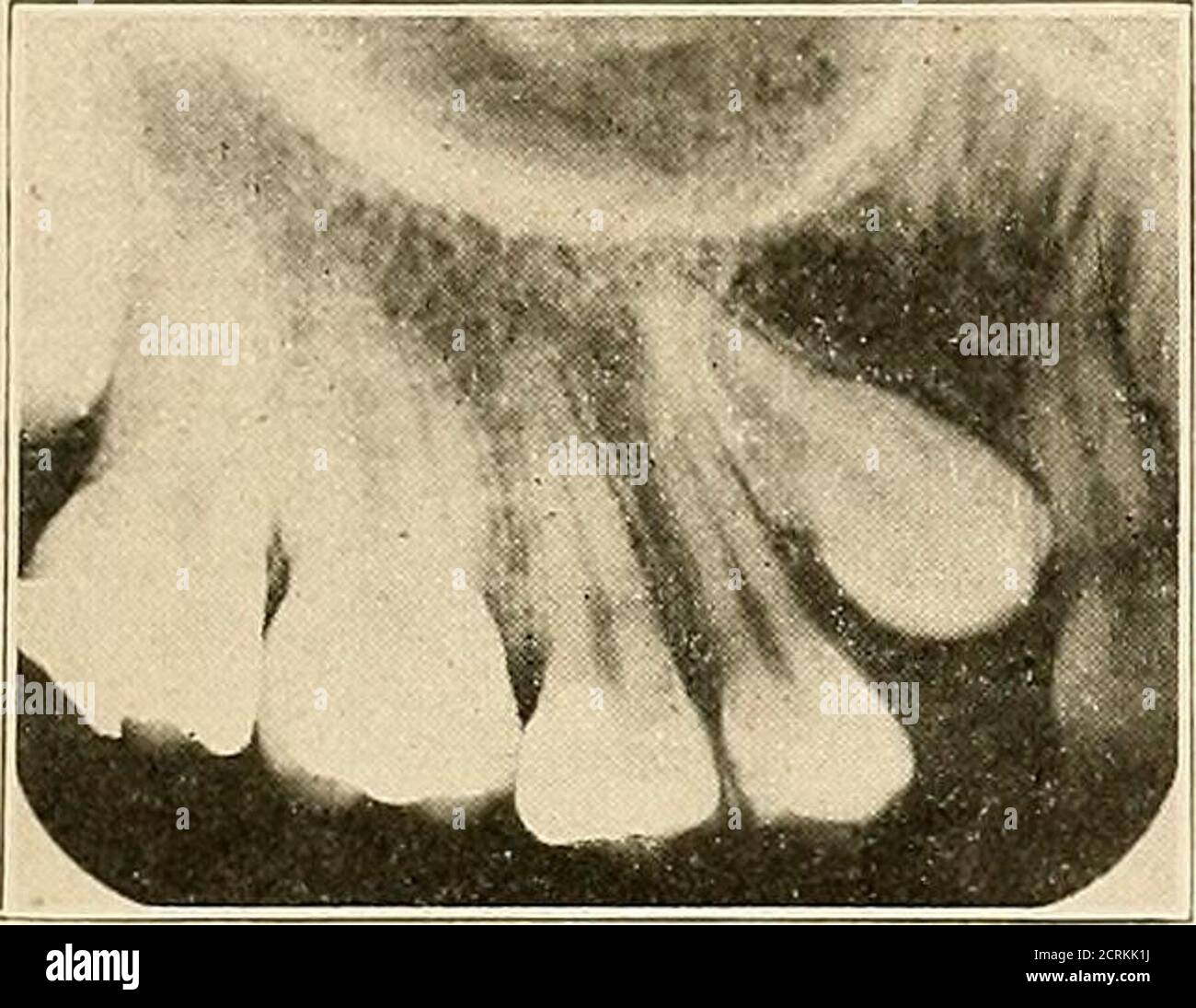 . Interprétation des roentogrammes dentaires et maxillaires . B. ^ZM Fig. 218.—R. Région