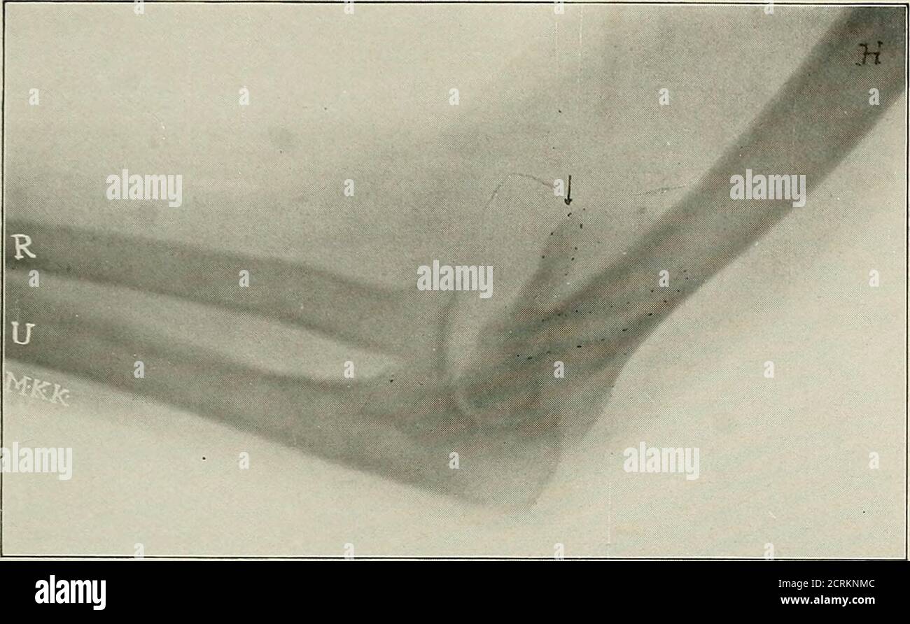 . Röntgen rayons et électrothérapeutiques : avec des chapitres sur le radium et la photothérapie . Figure 131.—Détachement d'une partie du condyle externe de l'humérus, vue antéro-postérieure. Figure 132.—la même vue latérale. 3, condyle interne; 4, olecranon fossa; 5, condyle externe ;6, procédé olecranon; 7, processus coronoïde de l'ulna; 8, centre d'ossification de la tête du rayon. (Cas du Dr Franklin Brady.). IIG. 133.—Détachement du muscle Loxgus du Svpinator, indiqué par la flèche.—la blessure-était considérée comme une fracture avant l'examen radiologique. (Cas du Dr H. C. Kellner.) r Banque D'Images