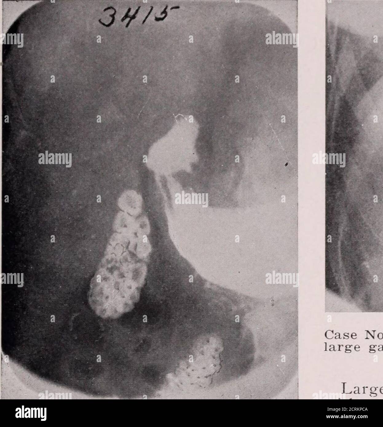 Journal de radiologie . Cas no 1416—une grosse pierre à Galle est  illustrée, cinq plus petites aussi, d'une manière immoqueuse à droite d'une  grosse pierre. Notez la présure de la vésicule