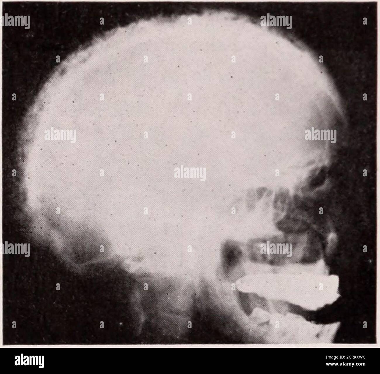 . Journal of Radiology . était slaightlystooping, ses jambes quelque part, sa tête large et pyra-midal en forme avec l'explainant. Les vaisseaux du thescalp étaient tortueux et sclérotiques. L'examen des yeux et des oreilles était négatif. L'urinalysisa montré une petite quantité d'albu-min Les réactions de Yassermann et de spinalfluid étaient négativeLa numération sanguine n'a montré aucun ab-normalitv et le taux basal métabolique de la maladie de PAGETS—carman et carrick était de +14. Le neurologicexamen n'a montré rien d'important, le résumé étant:ptose de la paupière droite, contin-double de platysma toright orbiculari Banque D'Images