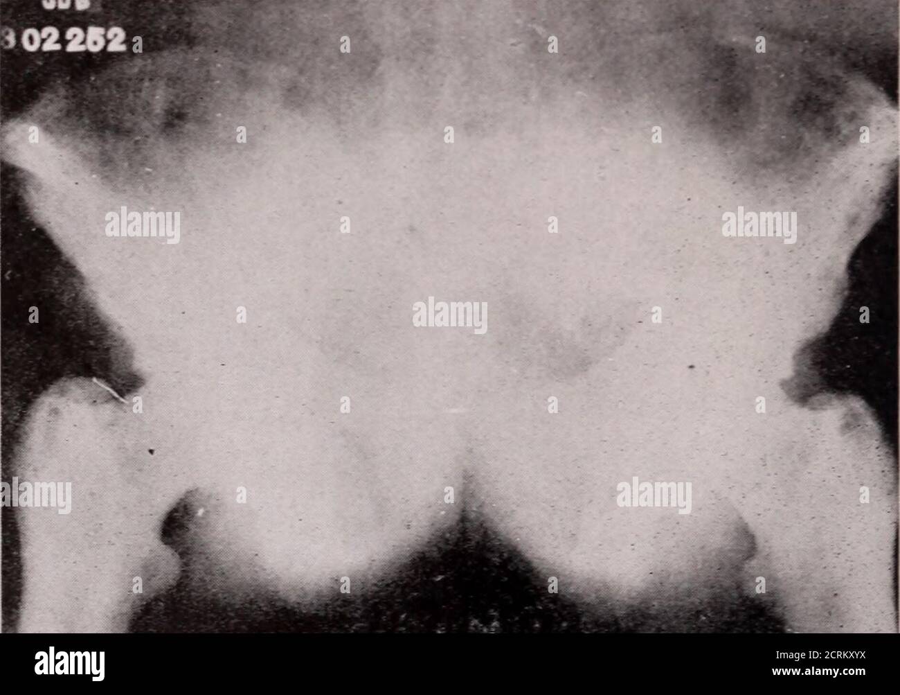 . Journal de radiologie . tumeur maligne x tasis. XO primarvLESION a été trouvé. Le patient a été équipé d'un renfort de back qui a soulagé les douleurs. Il est retourné à la clinique le 26 novembre, IQ20 pour le nouveau cas 302252—implication de l'examen sternum. Il a été claqué et les deux jambes se sont garrées vers l'avant et vers l'extérieur. Hesaid que sa tête s'agrandit et qu'il est environ trois inchesplus court qu'il ne l'était auparavant. Quand. Figure IX—CA«e 302252—épaississement marqué du bassin et des hanches et raréfaction des alae ilii. PA?e Fourtcri PAGETS MALADIE—CARMAN ET CARRICK sa colonne vertébrale a été ratrahi le pl Banque D'Images