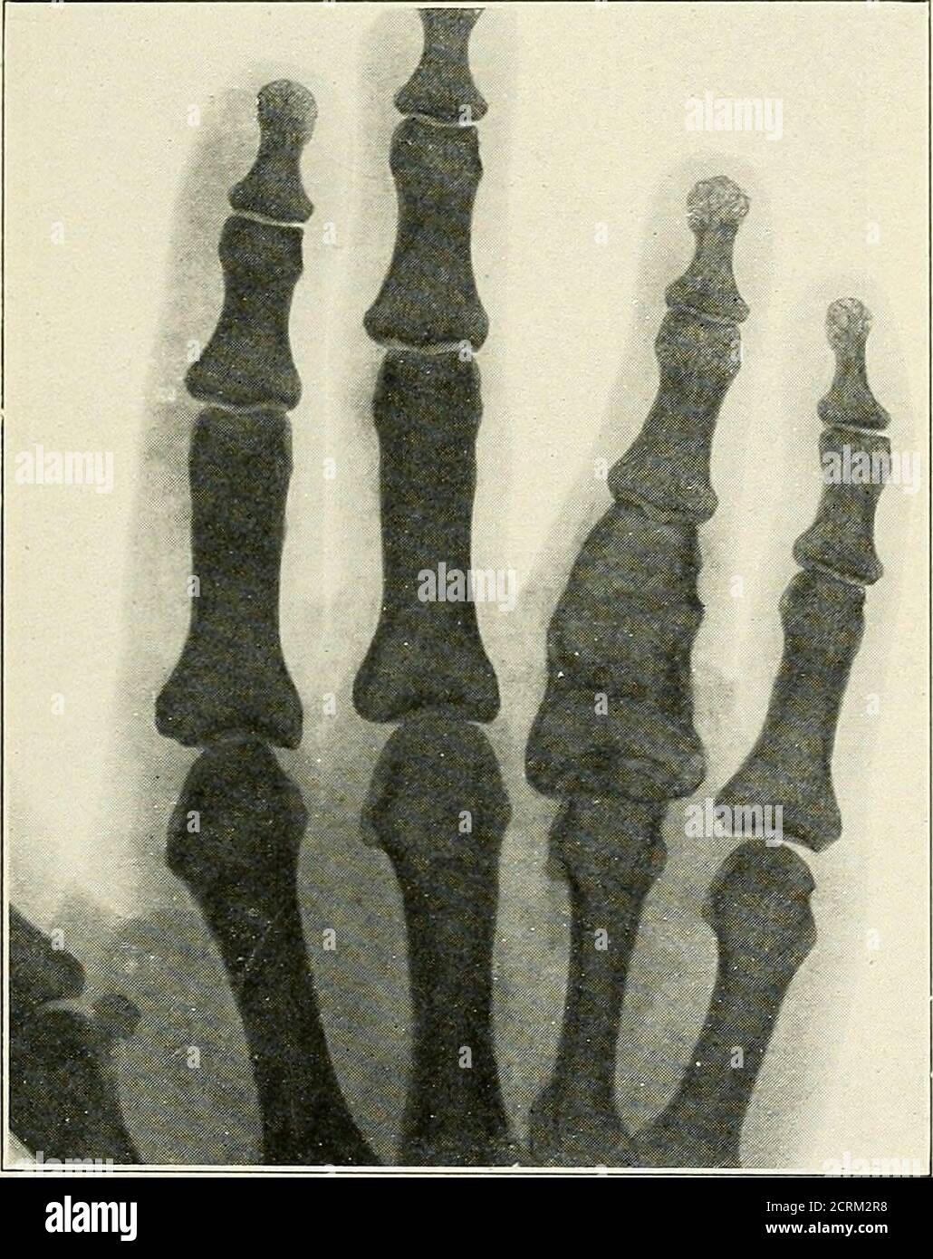 . Roentgen interprétation; un manuel pour les étudiants et les praticiens . Figure 43.—maladie de Pagets. Roentgenisation intensive. Cette tumeur, qui est de croissance lente, se produit comme une lésion isolée, habituellement près de l'extrémité d'un os long orin de la mâchoire. La croissance est excentrique, c'est-à-dire qu'elle provoque un hypertrophie asymétrique de l'os et tend à ballonnet le cortex plutôt que LES TUMEURS OSSEUSES 67 à se propager le long du canal médullaire. Habituellement, il ne traverse pas le cortex. La masse de la tumeur se compose de zones irrégulières de raréfaction contenant des trabeculae grossiers, quelque temps suggérant une masse de bulle de savon Banque D'Images