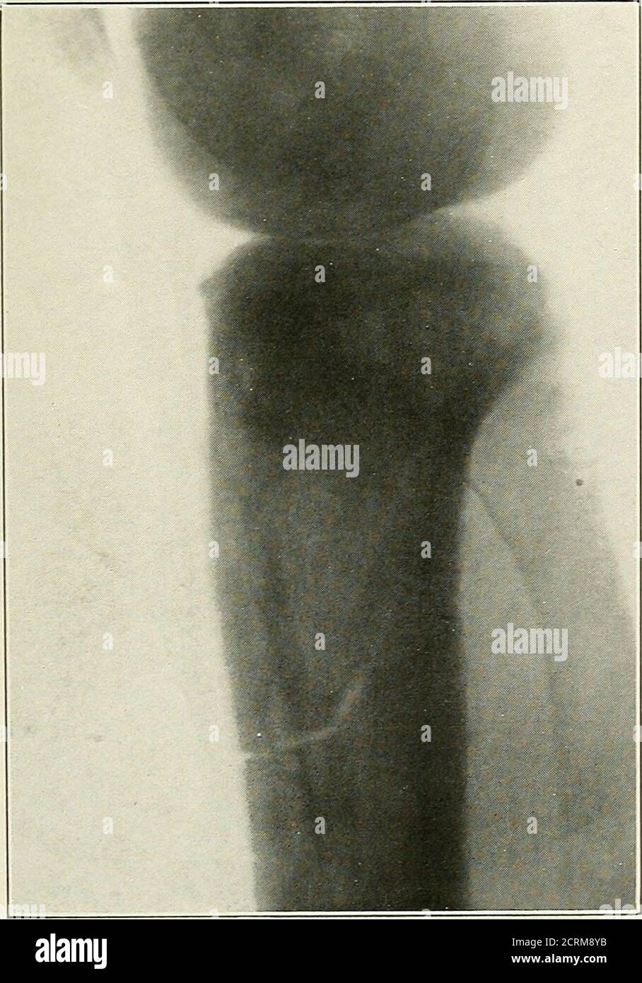 . Roentgen interprétation; un manuel pour les étudiants et les praticiens . Figure 18.—ancienne fracture du fémur, avec un grand callus et une difformité. Figure 19.—fracture pathologique de l'extrémité supérieure du tibia en cas de maladie de Pagets. Banque D'Images