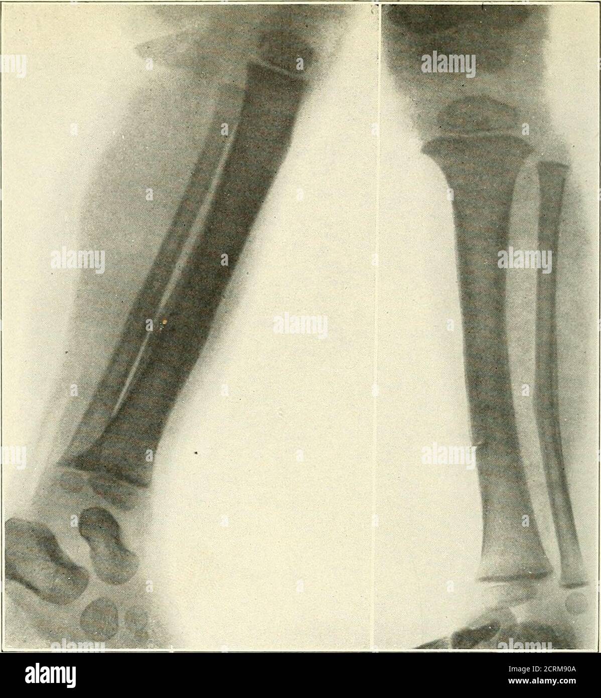 . Roentgen interprétation; un manuel pour les étudiants et les praticiens . Figure 19.—fracture pathologique de l'extrémité supérieure du tibia dans un cas de maladie de Pagets. Figure 20.^-fracture du tibisB avec une formationcalleuse considérable suggérant des changements périosteaux. Banque D'Images