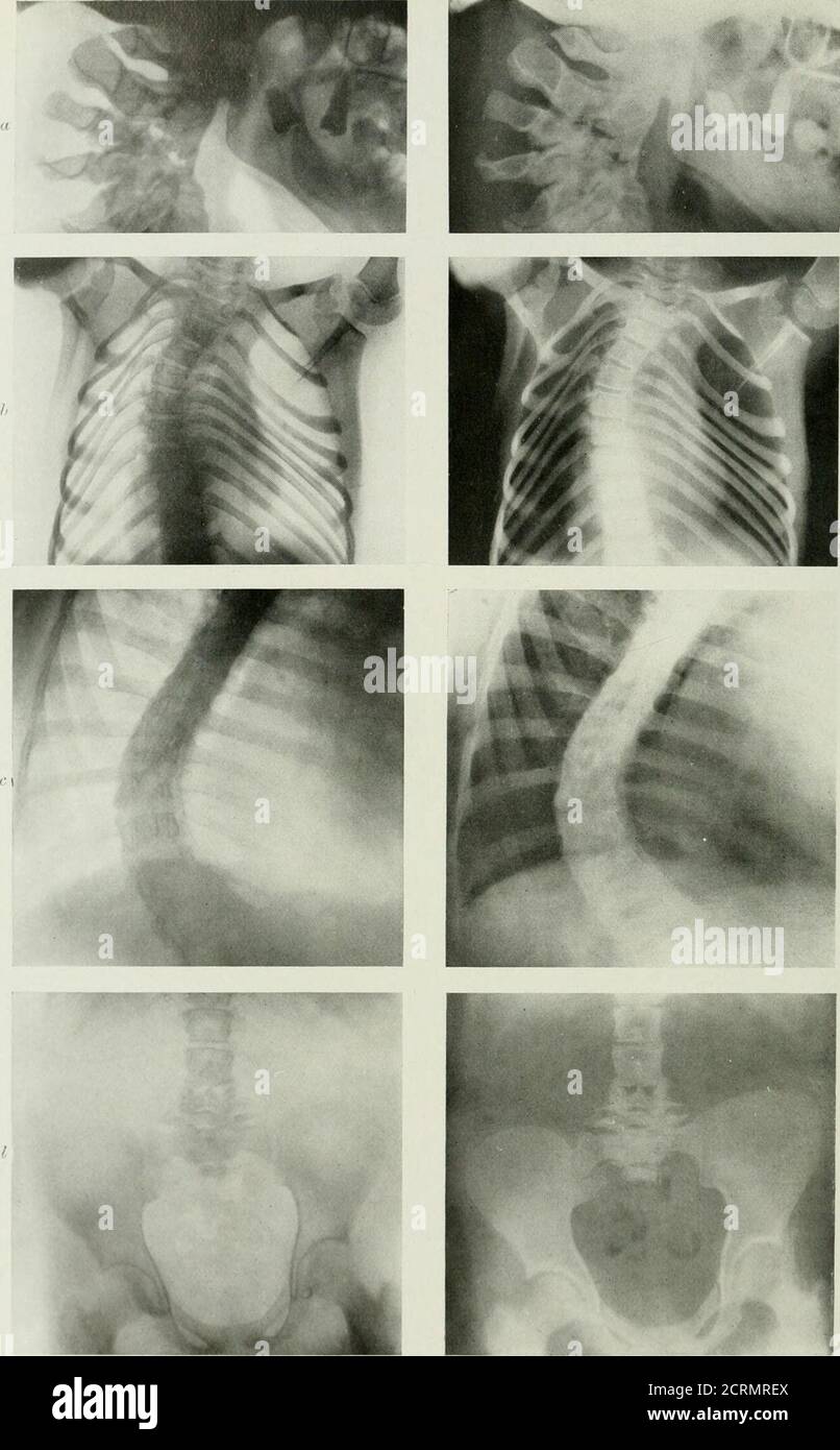 . Radiographie et radiothérapeutique . ILATE XFiV.—DisEASKs et Curvatoke de thi: Siwnk. , caries de vertèbres cervicales, vifw latérale. /, courbure de la colonne dorsale du ujper (scoliose). c, courbure de la colonne vertébrale, impliquant les vertèbres dorsales et lombaires inférieures. , caries de vertèbres lombaires et sacrum. MALADIE de CHARCOTS 269 des types précédents, caractérisée par une tendance à la formation de tissus nouveaux entre l'os et le cartilage articulaire, qui devient calcifié. Theremay être marqué de désorganisation des os. Spondylarthrite deformans.—arthrose affectant la colonne vertébrale.les changements pathologiques m Banque D'Images