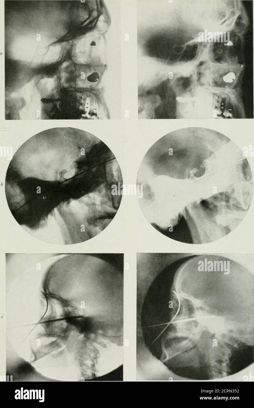 . Radiographie et radiothérapeutique . sa prise. L'articulation temporo-maxillaryaire de chaque côté peut être illustrée de façon satisfaisante en centrant le tubebebebebebebebebebebehind et un peu en dessous de l'angle de la mâchoire sur l'aspectplus éloigné de la plaque. La méthode la plus satisfaisante de montrer des blessures dans le thérégion de la mâchoire supérieure ou inférieure est sans aucun doute la stéréoscopique, l'advane étant que par cette méthode les pièces peuvent être vues dans la stéréoscopede chaque côté en changeant les plaques, c'est-à-dire dans une position, la surface du film est vers l'extérieur et dans la seconde, la surface en verre de la plaque est vers l'extérieur. ITIS p Banque D'Images