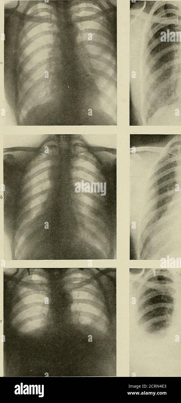 . Radiographie et radiothérapeutique . PLAQUE LVII.—coffres présentant des changements dans le coeur et les poumons. A, pneumonie lobar, localisée au lobe supérieur droit. b, carcinome secondaire du médiastin se propageant dans la substance pulmonaire. c, coeur fortement agrandi. Hypertrophie et hydropéricarde.. Banque D'Images
