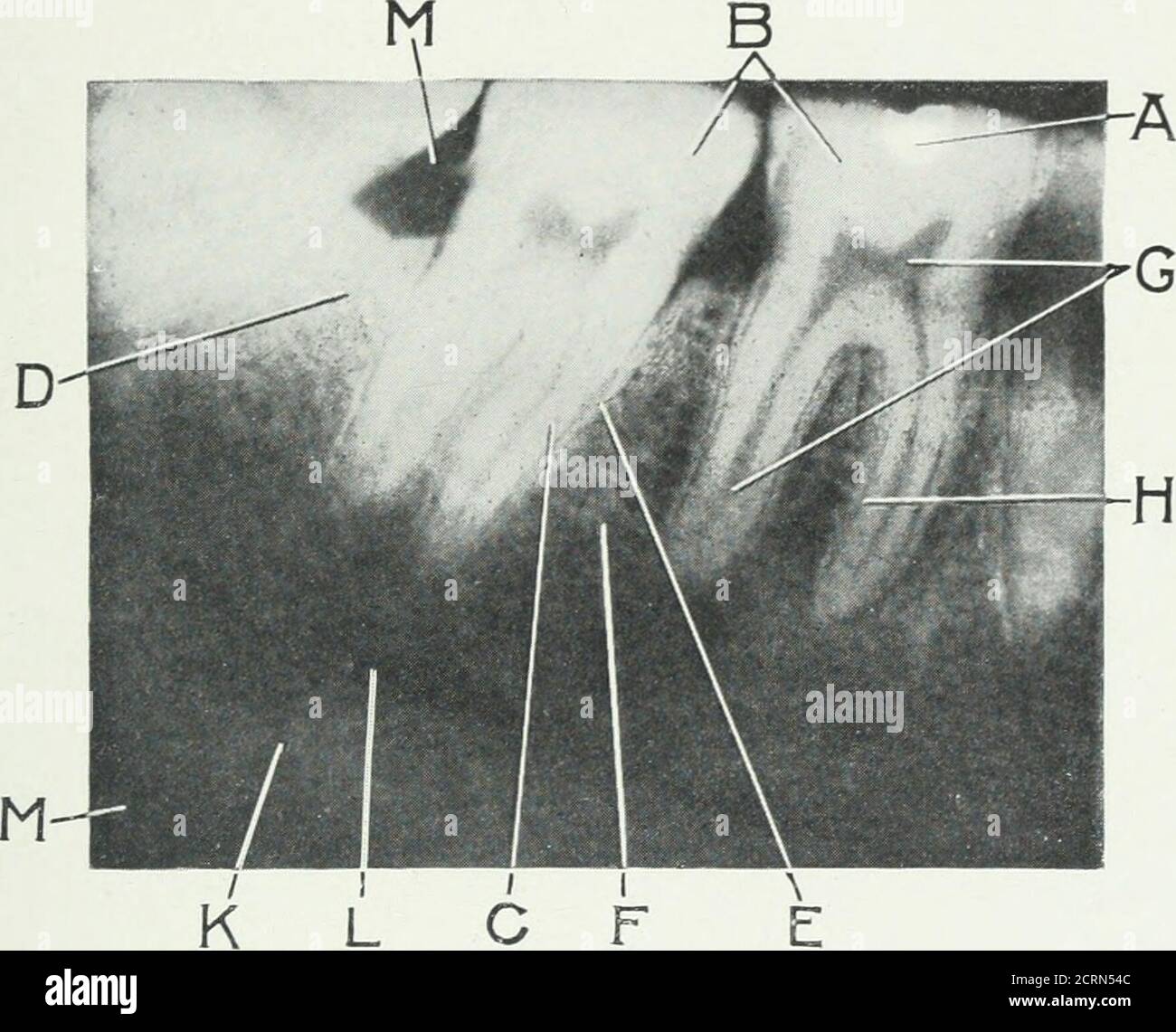 . Radiologie dentaire . effet cal sur un pastil préparé exposé simultanément.ce pastil chimique change de couleur pendant son exposition aux therays et la nuance de couleur est comparée à une échelle devisedpar Sabouraud. L'intensité des rayons est mesurée en unités calledHolznechts, ou comme on parle généralement de HS.pour l'examen-pie, la dose nécessaire pour produire le légèrement testerythema sur le visage d'un adulte est équivalente à trois des 135 unités Holznecht, ou 3H. Maintenant, la plus grande dose nécessaire pour la prise d'une radiographie n'est qu'une petite fraction d'une seule unité H. Vous verrez alors Banque D'Images