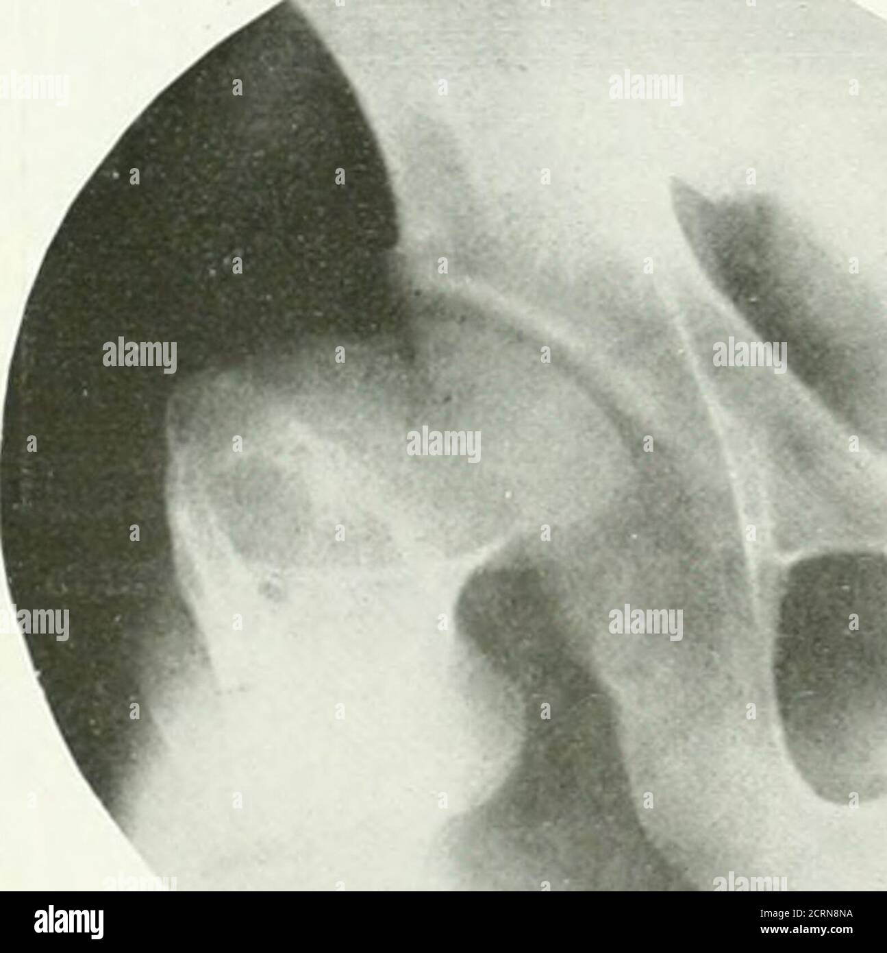 . La revue américaine de roentgoenologie, de radium thérapie et de médecine nucléaire . Figure 4. Cas IV Ostéondrite guérie bilatérale delornLins juvenilis. Servi dans la guerre mondiale. Tion, qui sont si communs après le tubercu- l'épiphyse est progressive, étant légère à la hanche-joint de lous, ne se produisent pas. hrst, Et l'augmentation jusqu'à ce que l'épiphyse perd le roentgenogramme, quand on le voit, est son contour arrondi et est réduit à un très typique, tant que la plupart des auteurs aplatis plaque ou disque, souvent divisé en 704 Osteondrtis deformans Juvenilis plusieurs segments. Plus tard, ils apparaissent tofuse, et le Banque D'Images