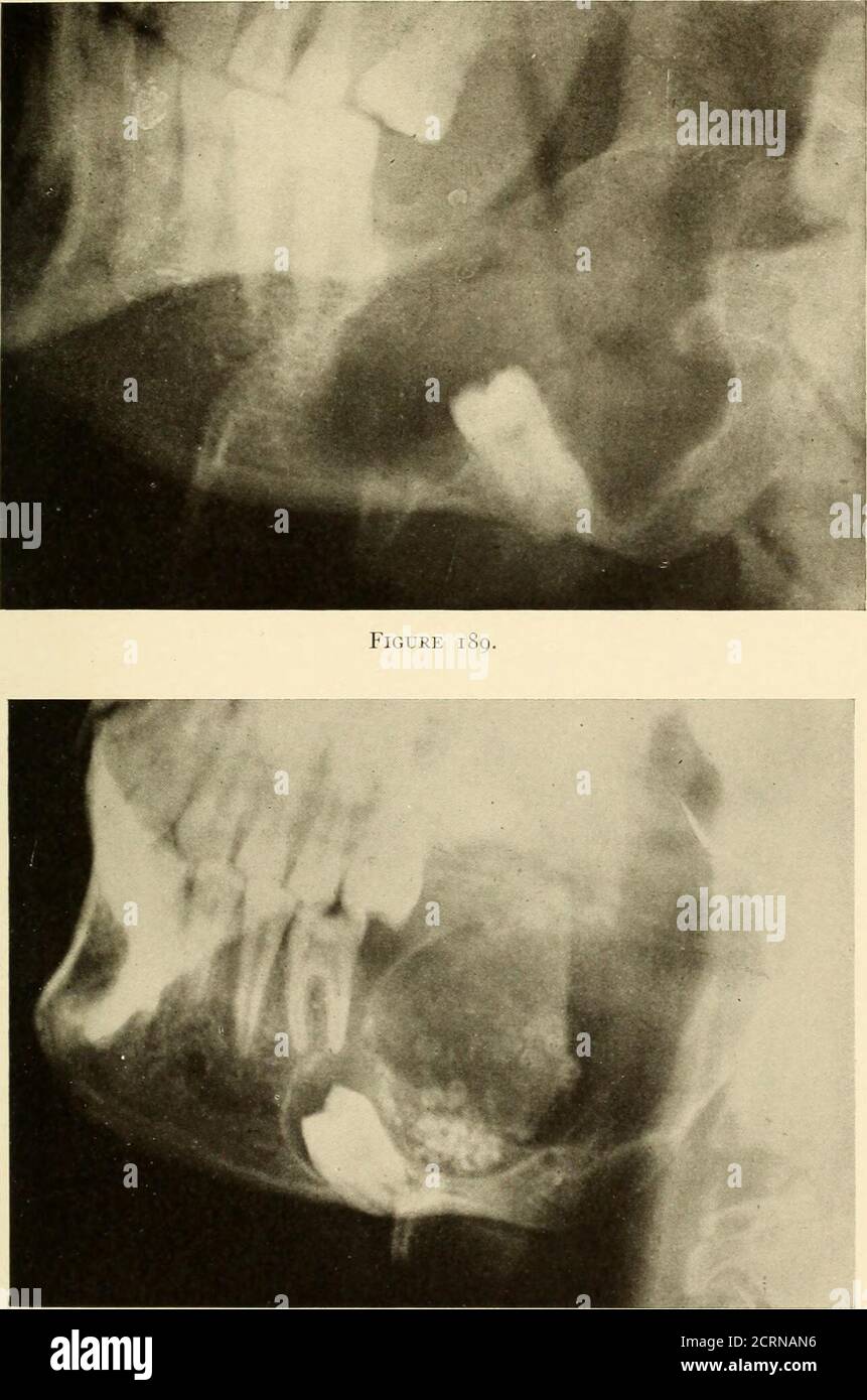 Roentgoenologie Orale Etude Roentgen De L Anatomie Et De La Pathologie De La Cavite Buccale Machoire L Essaimingementavait Ete Remarque Pendant Neuf Mois Et A Ete Attribue A Un Coup Il Roentgoenologie Orale Etude Roentgen De L Anatomie Et De La Pathologie De La Cavite Buccale Machoire L Essaimingementavait Ete Remarque Pendant Neuf Mois Et A Ete Attribue A Un Coup Il