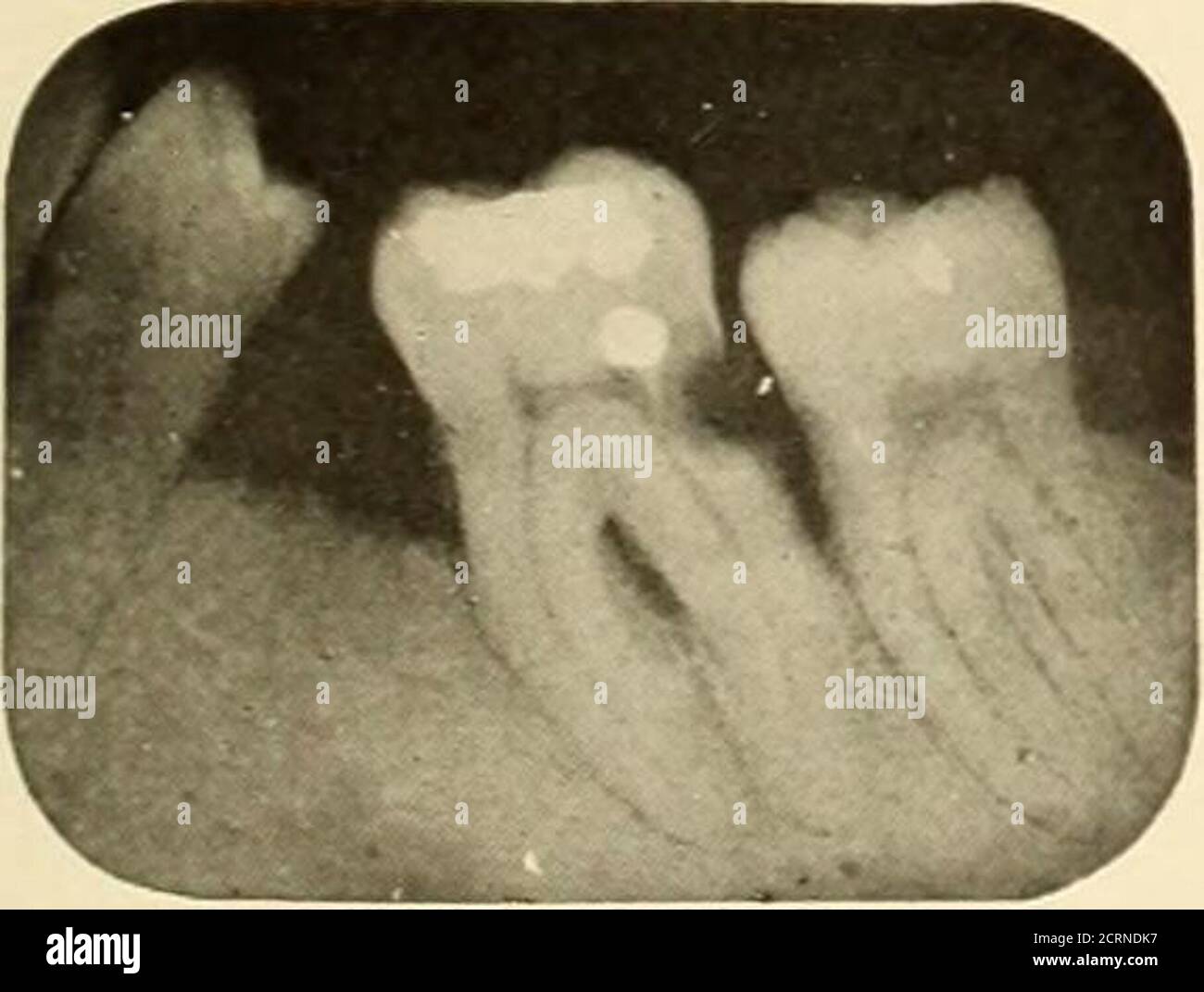 . Roentgoenologie orale : étude de Roentgen sur l'anatomie et la pathologie de la cavité buccale . Figure 86.. Banque D'Images