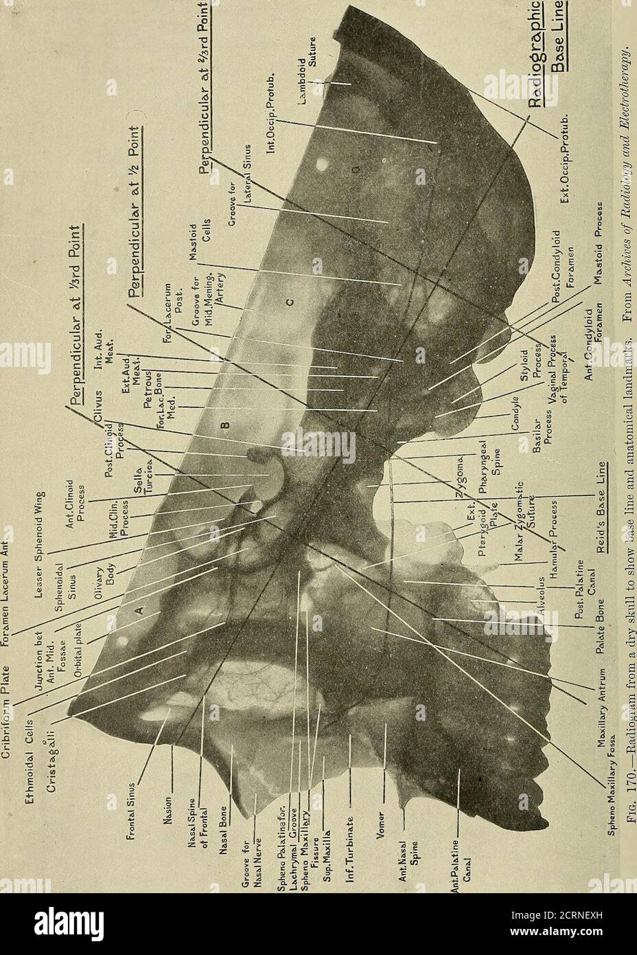 . Radiographie et radiothérapeutique . e cerveau, et divise grossièrement le visage du cuir chevelu poilu. La perpendiculaire à la moitié de la distance correspond approximativement à son extrémité supérieure avec la fissure de Rolando, et au-dessous de la ligne de base avec la marge postérieure du ramus ascendant de la mâchoire inférieure. La perpendiculaire à la distance des deux tiers divise le lobedu pariétal du cerveau. Ces trois lignes divisent la tête en quatre régions qui peuvent être calledA, B, C, D, de l'avant vers l'arrière. L'Eegion A contient la fosse antérieure du crâne avec la moitié antérieure du lobe frontal, les orbites et Banque D'Images