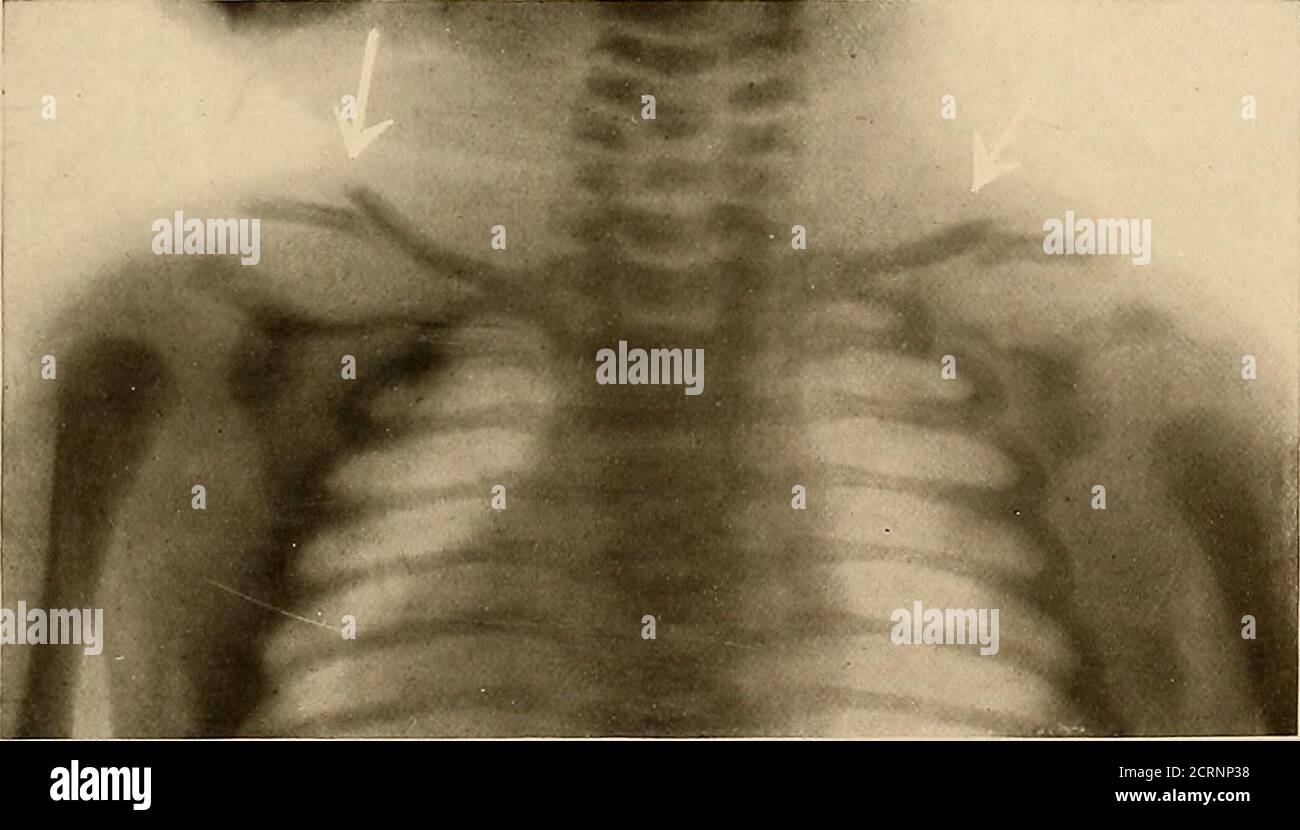 Fractures de naissance et dislocations épiphysales . Figure 20.—fracture de  naissance de l'hutte de Clark site habituel de la fracture, avec le  déplacement habituel, semblable à celui observé chez l'adulte.ces fractures,