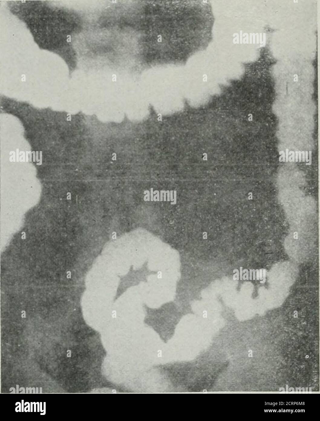 La revue am ricaine de roentgoenologie de radium th rapie et de