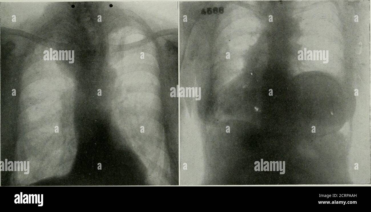 Nodule pulmonaire Banque de photographies et d’images à haute — free download