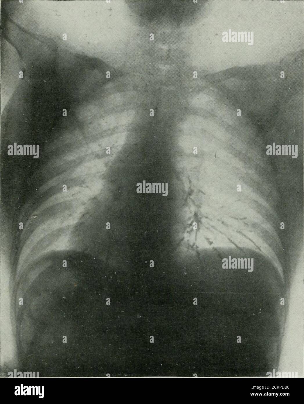 La Revue Americaine De Roentgoenologie De Radium Therapie Et De Medecine Nucleaire Grandes Cjuan Tities De L Air L Examen De L Abdomen A Montre Une Distension De L Estomac Il Y A ac Grand