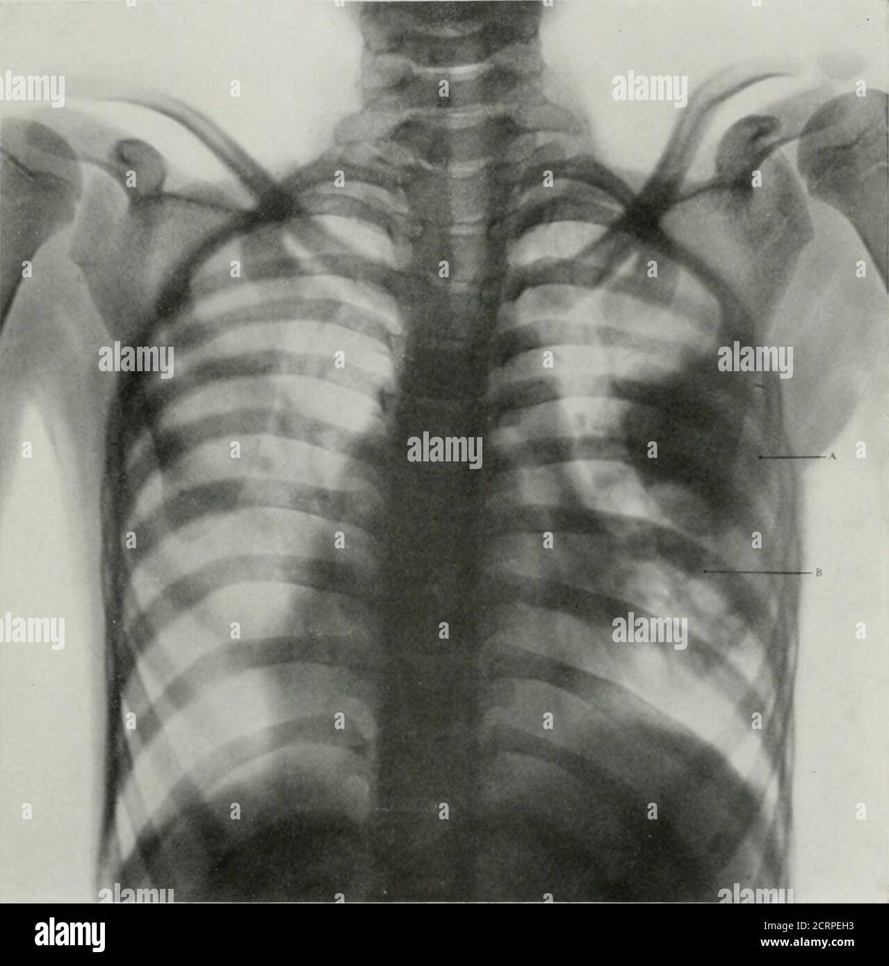 Tuberculose Miliaire Banque D Image Et Photos Alamy