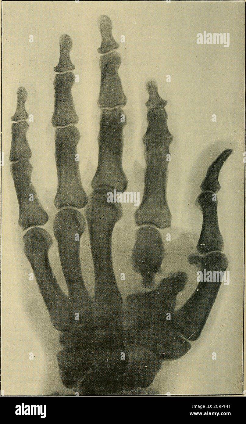 . Les rayons de Röntgen dans le travail médical . themétacarpal et phalanges du pouce les tendons extenseurs peuvent être tracées à beclEarly. Le tendon de l'extenseur secundi internodii,en effet, peut être suivi jusqu'à son insertion à la base du phalange de theterminal. Malheureusement, beaucoup des disques les plus faibles arelost dans la reproduction. Main. Comme prévu, les méthodes Rbntgen ray ont montré que les fractures des métacarpes sont plus fréquentes que ce que l'on croyait auparavant.il y a généralement peu de déplacement, puisque les métacarpanos voisines agissent comme des attelles efficaces. Dans certains cas où il y a déplacement latéral, le raccord est dans Banque D'Images