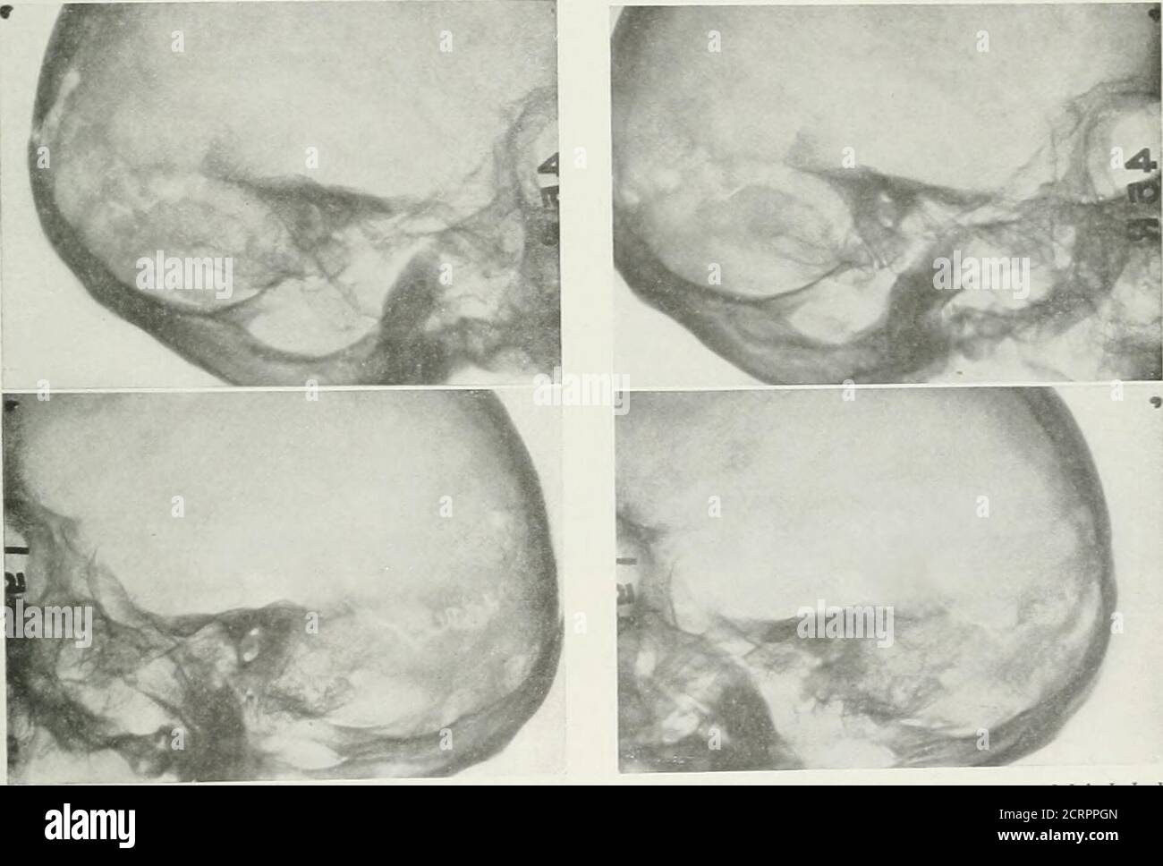 . Le journal américain de roentgoenologie, radium thérapie et médecine nucléaire . ou coin de chaque, de sorte que sur l'examen suivant, il est simplement nécessaire de tourner le filmsover, de sorte que les nombres soient lus vers l'arrière, les tourner latéralement jusqu'à ce que les nombres soient au sommet, et puis placez-les dans les boxesavec les marques de punch à l'arrière, c'est-à-dire à l'écart de l'observateur. Une NOUVELLE MÉTHODE DE STEREOSCOPICOBSERVATION SIMULTANÉE DES DEUX MASTOIDS PAR PAUL C. HODGES, M.D.du Département de Roentgoenologie, Peking Union Medical College PÉKIN, CHINA HILL et Thomas, écrivant dans l'American Atlas oj Stereoroentgenol Banque D'Images