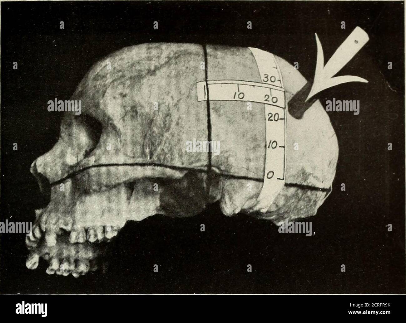 Trimestre américain de roentgoenologie . Figure 2.—crâne montrant l'angle  approprié pour les skiagrammes mastoïdes. Figure 3. — UN mastoïde adulte  normal.—Sidney Lange, M. D. Lange: Examen mastoïde 5 exposer l'autre moitié.