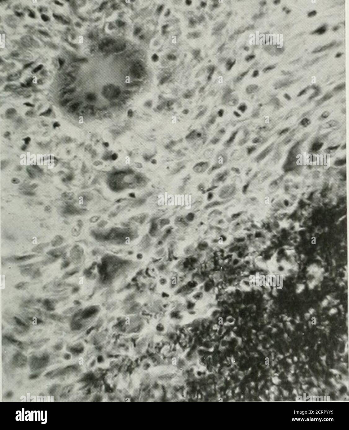 . La revue américaine de roentgoénologie, radium thérapie et médecine nucléaire . parated de la diaphyse du fémur et l'épiphyse du greatertrochanter. La destruction osseuse de la ligne.épiphysaire du trochanter extendedon de la diaphyse pour environ i cm., se terminant dans un éperon de l'os élevé i cm. Inheight. Il n'y a pas eu de changement dans le théacetabelum ou la tête du fémur. La ligne de Theepiphyseal pour la tête du fémur était normale. Dans les structures douces au-dessus de l'épiphyse trochantérique droite, il y a une Epiphysitis tubéculaire ombre du grand trochanter 55*, de la taille et de la forme d'une norme Banque D'Images