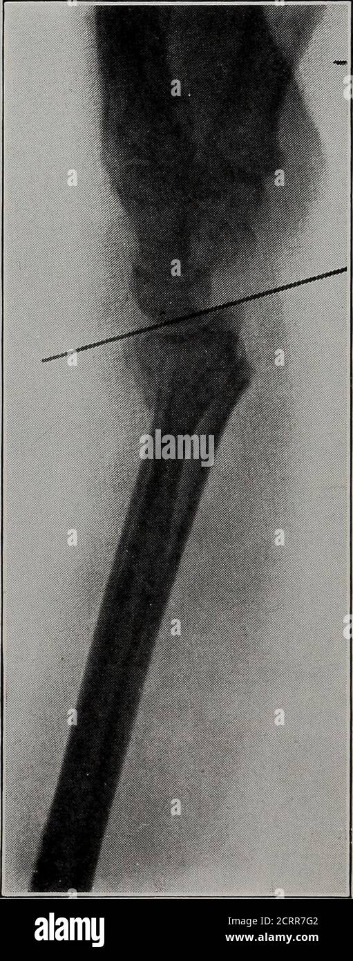 Fracture de la tête radiale Banque de photographies et d’images à haute ...