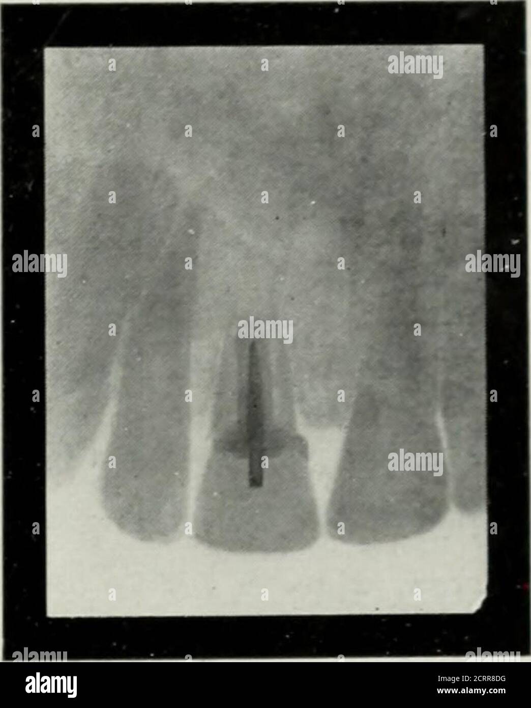 . Radiographie élémentaire et dentaire . Figure 222 Fig. 22.3 Fig. 222. Identique à la Fig. 219. La cavité de l'abcès remplie de pâte de subnitrate de bismuth. Figure 223. Identique à la Fig. 219, trois mois et demi après l'opération. La cavité de l'abcès est entièrement remplie de nouvel os. Le nouvel os n'est pas encore aussi dense que l'os environnant. Ou la pâte n'aura pas l'effet curatif désiré. Chaque suceur doit être rempli, je concède. Mais je vous montre maintenant un cas dans lequel le sinus n'a pas été tout à fait rempli, et, comme nous allons voir actuellement, les therésults obtenus ont été idéaux. Trois jours après Banque D'Images