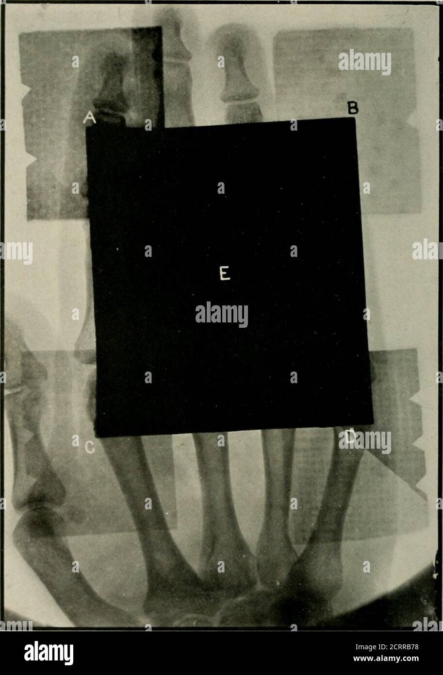 . Radiographie élémentaire et dentaire . Figure 311. A. B. C et D sont des morceaux de linoléum. E, un morceau de feuille de plomb de 1-16 pouce d'épaisseur. Appareils pour la protection. Les appareils pouvant être utilisés pour la protection contre les rayons X sont les suivants : écrans de protection des dérivations (Fig. 314 et 315), armoires de protection des câbles (Fig. 316 et 317), protections du tube (Fig. 60, 61, 63 et 64, chapitre HI et Fig. 318), tubes à rayons X de protection ou de sécurité (Fig. 319), gants résistants aux rayons X (Fig. 320), lunettes en verre de plomb(Fig. 321), et des tabliers de protection. RADIOGRAPHIE DENTAIRE. Figure 818. A. B, C et l». BAME comme sur la Fig. 811. Banque D'Images