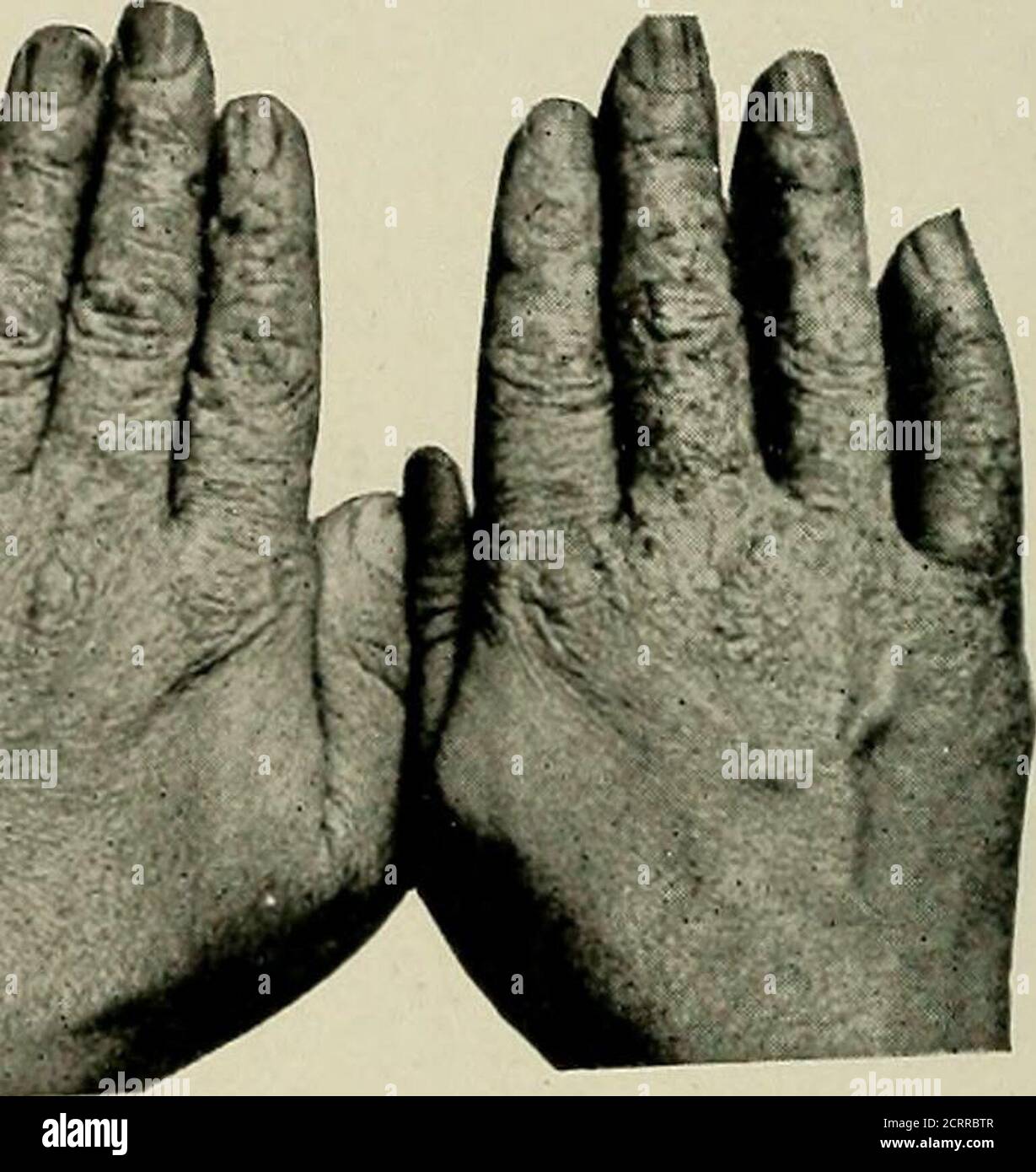 . Radiographie élémentaire et dentaire . la peau devient dure et sèche ...