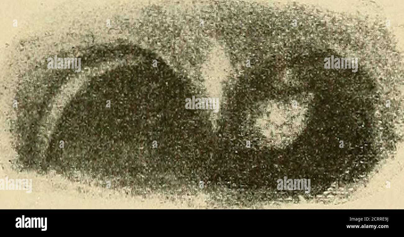 . Maladies du nez et de la gorge . Figure 78.—Dr Accorde le cas du polypus post-nasal. Polypus, alors que son absence de pression à l'intérieur du naso-pharynx lui permet d'atteindre une taille beaucoup plus grande (Fig. 78). Pathologie : le site d'origine du polypus influence son caractère pathologique. Le polypus mucus ordinaire a son origine usuallyle long du sommet du meatus moyen entre le turbi-né moyen et la paroi externe, d'une muqueuse pure. Lorsque la thémucosa descend vers le bas sur le corps du turbinatedet inférieur vers le choana post-rhinal, les tissus fibreux et conjonctifs élé wi Banque D'Images