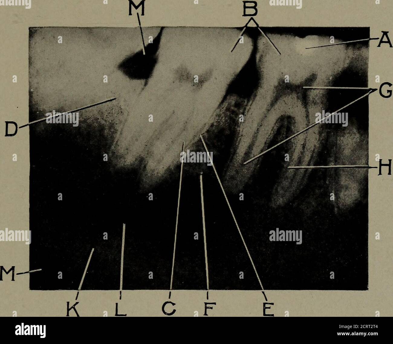 . Radiologie dentaire . effet émique sur un pastil préparé exposé simultanément.ce pastil chimique change de couleur pendant son exposition aux therays et la nuance de couleur est comparée à une échelle devisedpar Sabouraud. L'intensité des rayons est mesurée en unités calledHolznechts, ou comme on parle généralement de HS.par exemple, la dose nécessaire pour produire le légèrement tésterythema sur le visage d'un adulte équivaut à trois des 135 unités Holznecht, ou 3H. Maintenant, la plus grande dose nécessaire pour la prise d'une radiographie n'est qu'une petite fraction d'une seule unité H. De cette, vous allez Banque D'Images