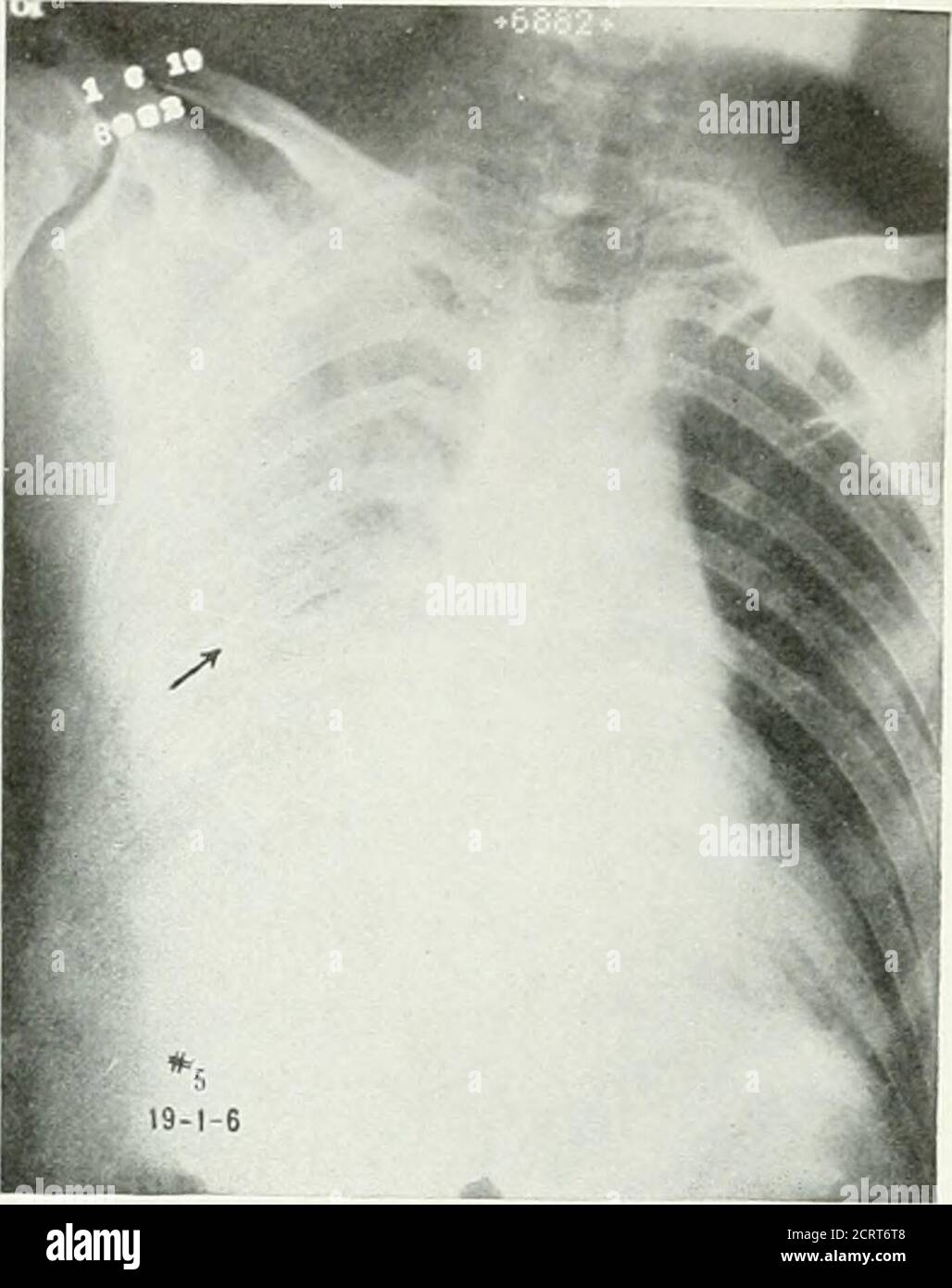 . La revue américaine de roentgoenologie, de radium thérapie et de médecine nucléaire . Figure 3. Aucune preuve de participation pulmonaire. Figure 4. Montre une plèvre interlobar de début betweeChows les poumons normaux. Les lobes supérieurs et centraux à droite, associés à une légère noisette du lobe droit central. 224 H ;.-pneumonite morrhaïque. Banque D'Images