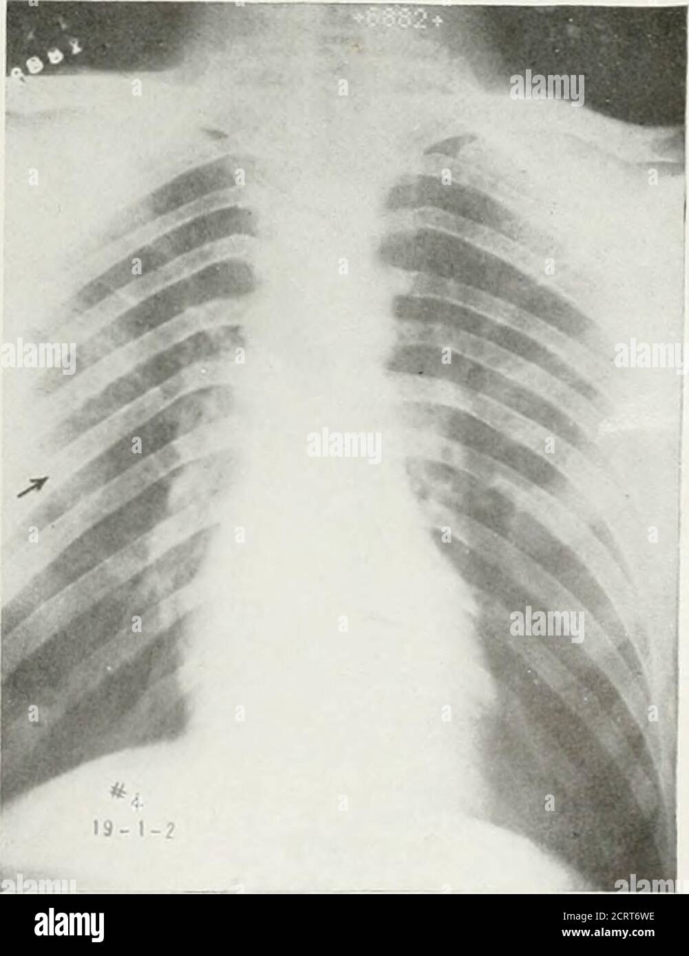 . La revue américaine de roentgoenologie, de radium thérapie et de médecine nucléaire . Figure 3. Aucune preuve de participation pulmonaire. Figure 4. Montre une plèvre interlobar de début betweeChows les poumons normaux. Les lobes supérieurs et centraux à droite, associés à une légère noisette du lobe droit central. 224 H ;.-pneumonite morrhaïque Banque D'Images