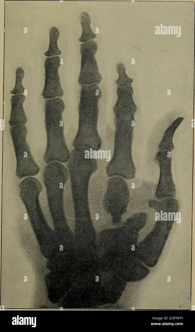 . Le Röntgen rayons dans le travail médical . ne,montre quelques bons enregistrements de muscles et d'autres structures douces.ainsi, dans le côté extérieur du petit doigt métacarpal peut trahir les muscles de l'abducteur et de la flexion du brevis. Sur le côté extérieur des articulations du milieu des deuxième et troisième doigts sont whatsemble être les expansions latérales de l'extenseur commun des chiffres. Le long de l'arrière des os des andphalanges métacarpiennes du pouce, les tendons extenseurs peuvent être tracés à blanc. Le tendon de l'extenseur secundi internodii, en effet, peut être suivi jusqu'à son insertion à la base du terminalphalanx Banque D'Images